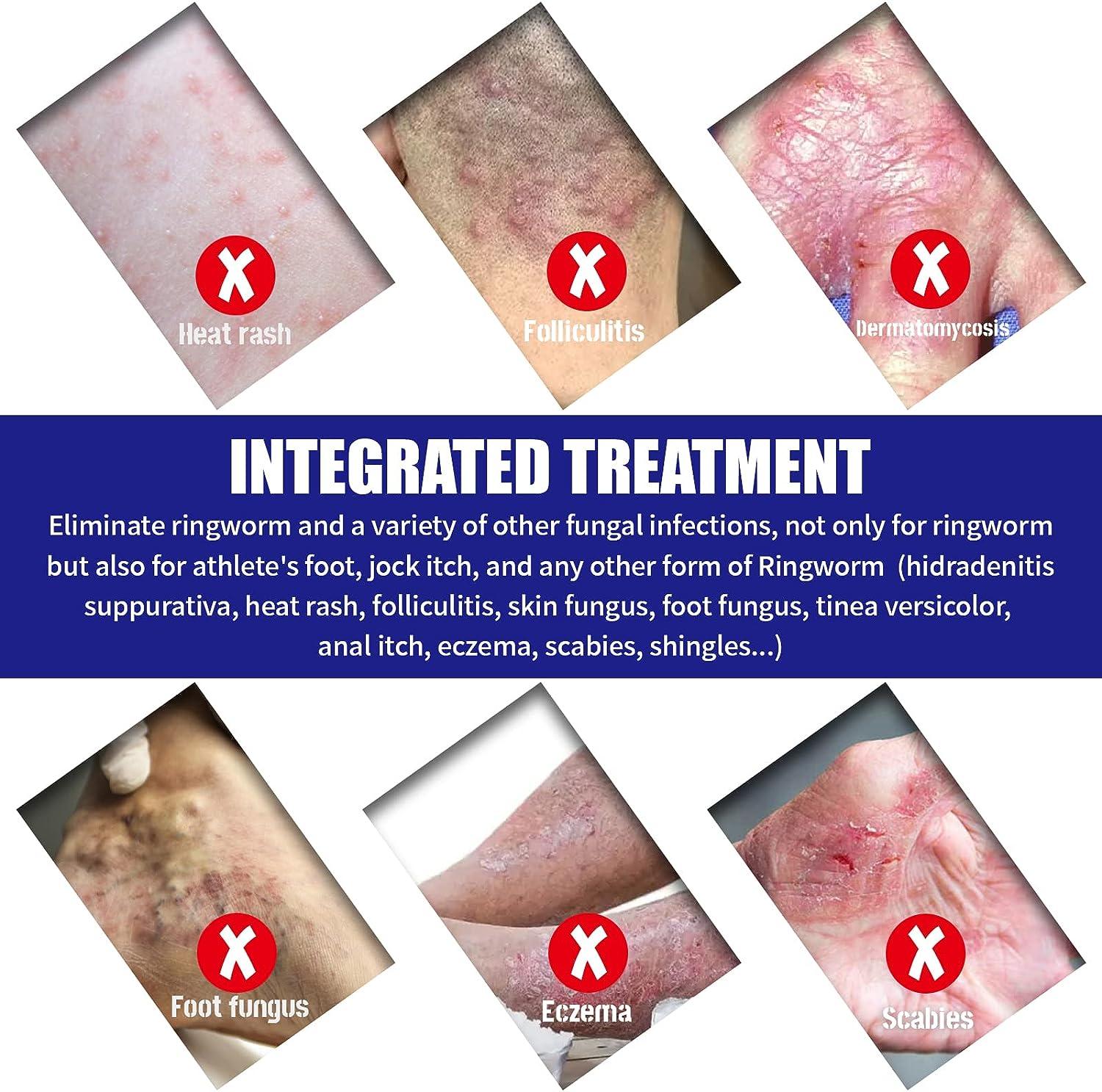 Foot Rash Cream for Itchy Feet Relief Jock Itch, Ringworm, Psoriasis