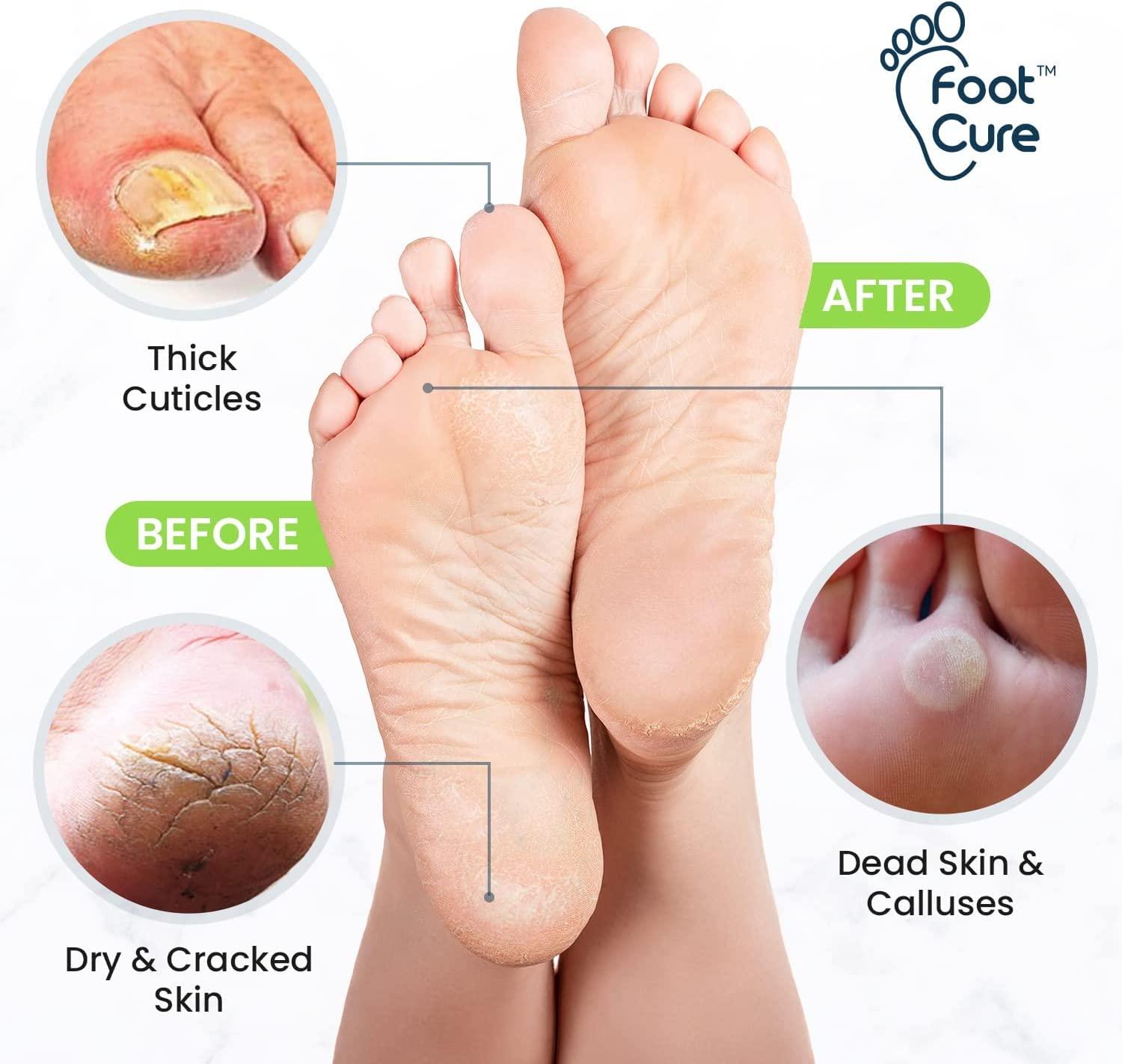 The Foot Medic Moisturizing Socks & Foot Cream: Cracked Heel Treatment –  TweezerCo