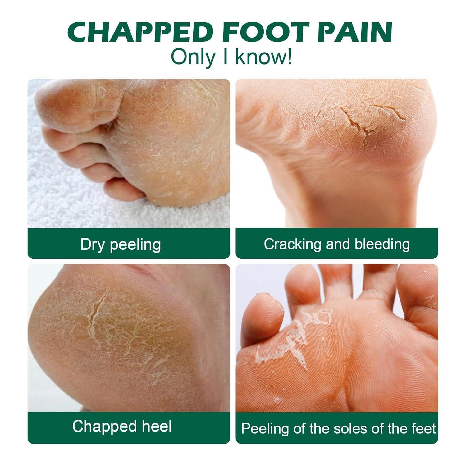 Peeling Off Bottom Of My Feet Are Dry And Cracking Itchy My Feet