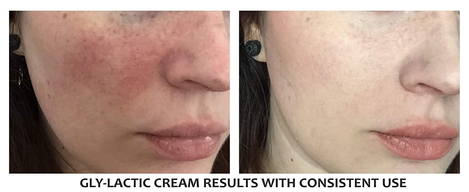 20 GlyLactic Exfoliating Cream 10 Glycolic & 10 Lactic Acid for