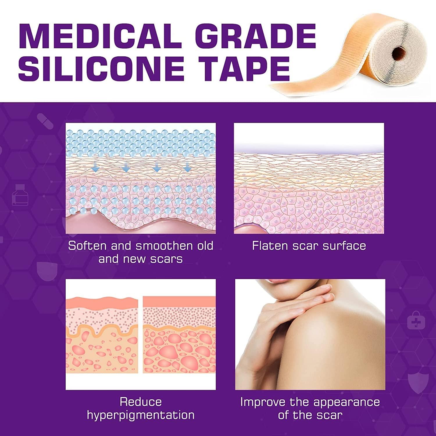 keusn soft silicone tape for scar removal (1.6'' x 120'') scar treatment, silicone  sheets, keloid bump removal easy removal 