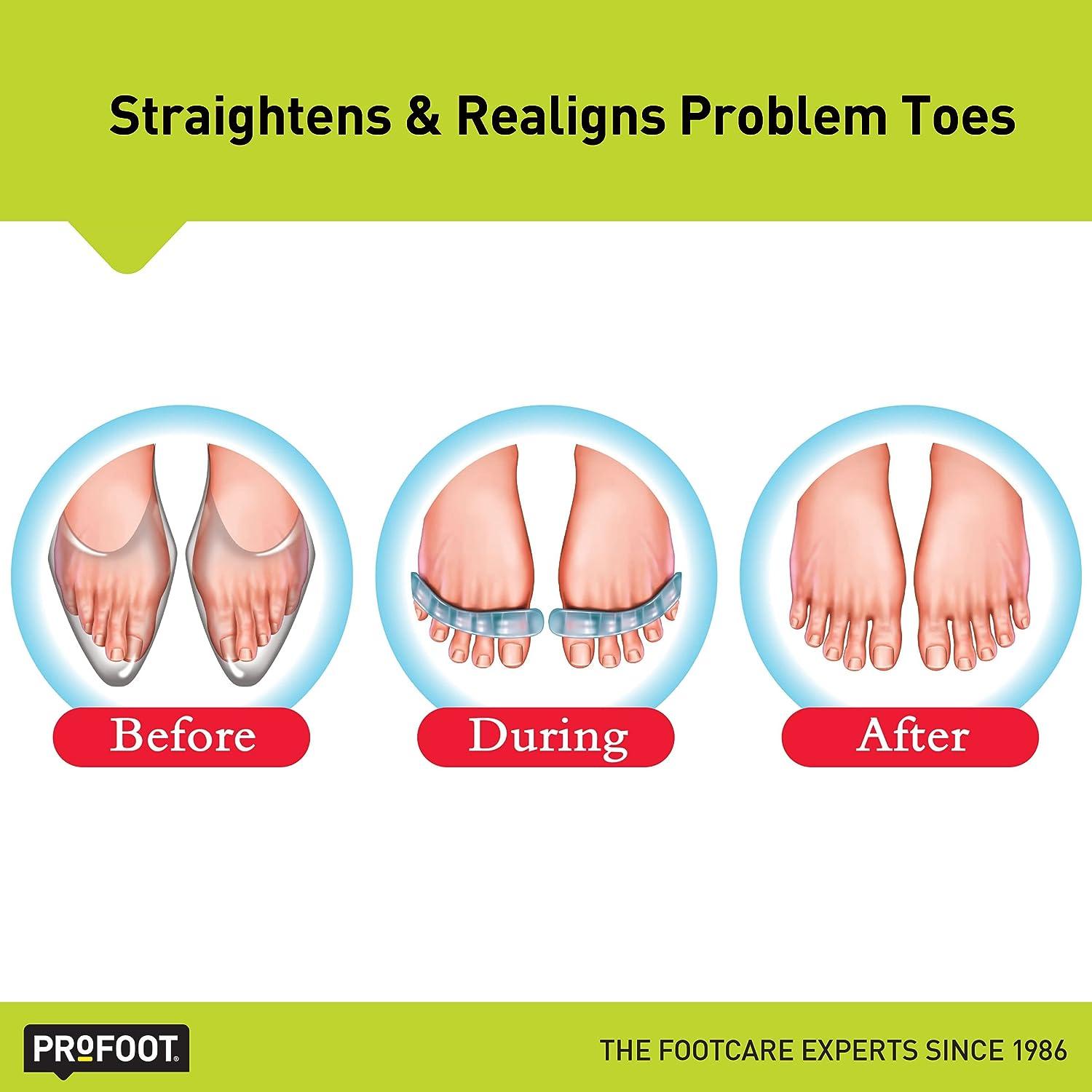 PROFOOT Flextastic Toe Spacers Gel Toe Separators for Foot Pain