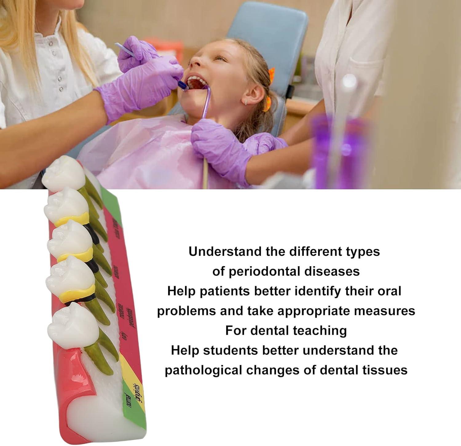 Realistic Dental Periodontitis Model - Study Dental Teeth in Various ...