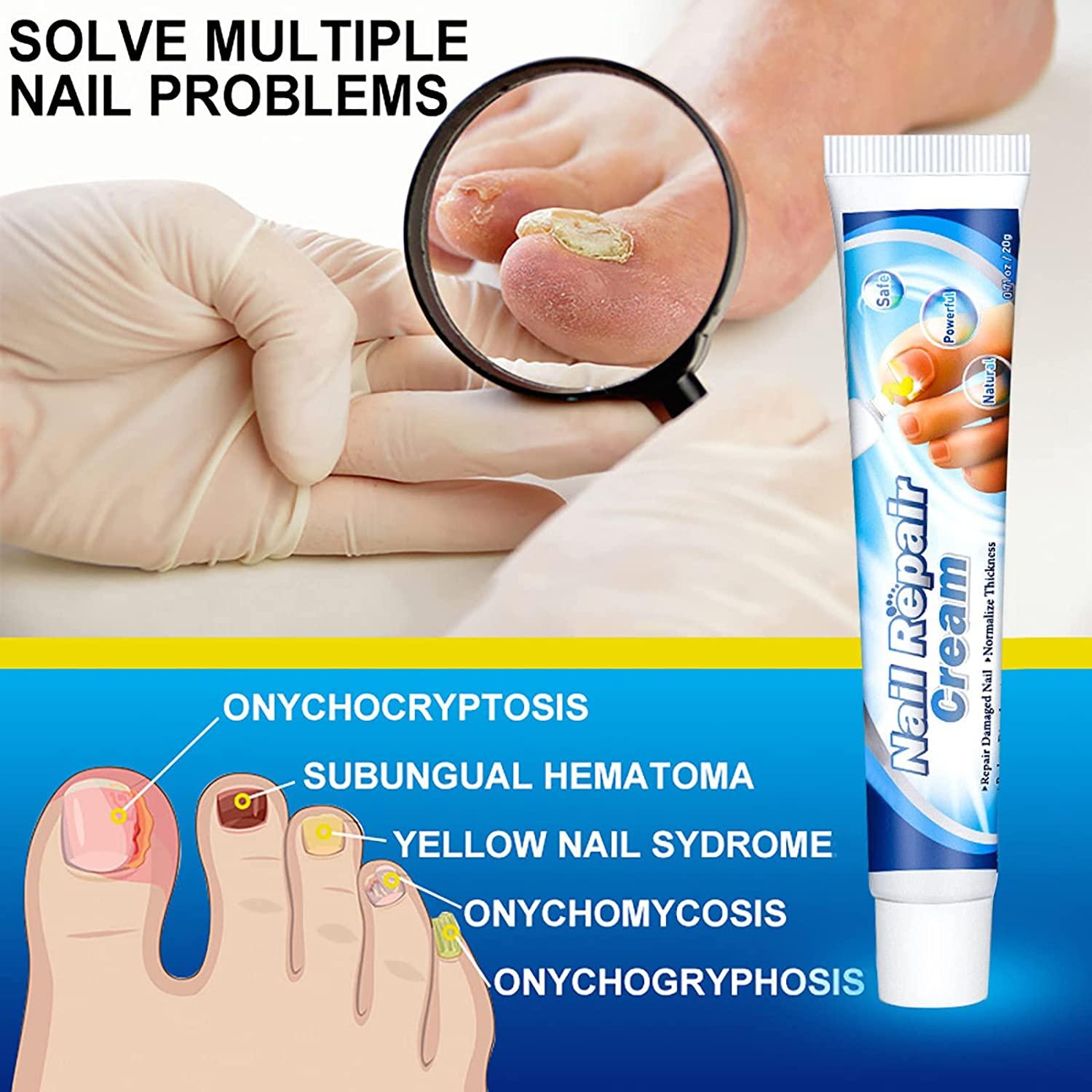 Maximum Strength Nail Repair Cream for Toenail Fungus Treatment 20g