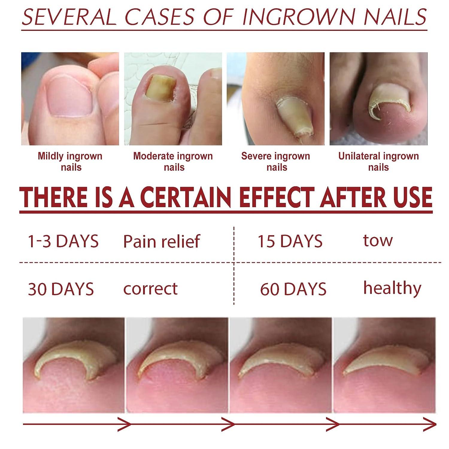 How to Rid Yourself of Toenail Fungus? - By Dr. Abhay Talathi | Lybrate