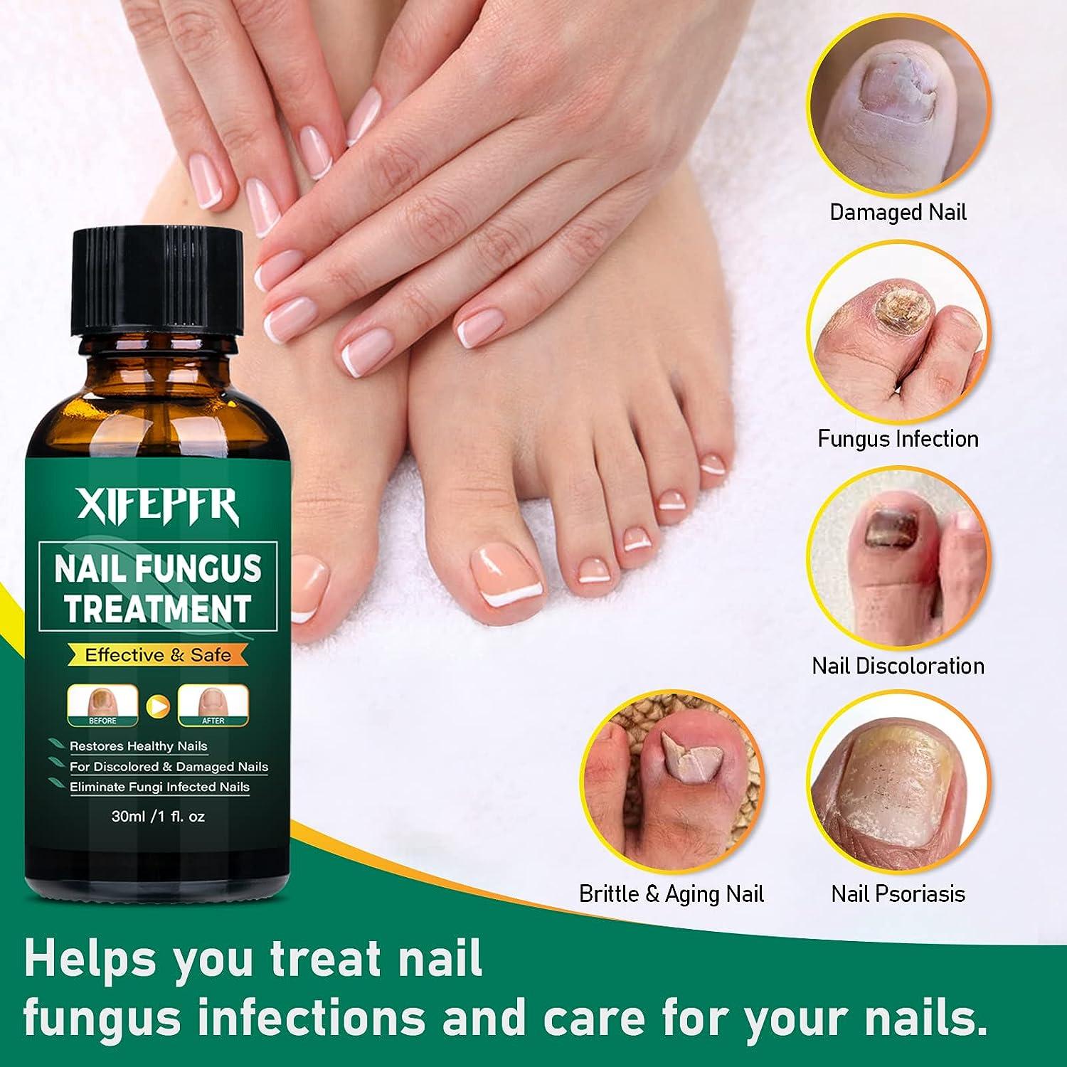 XIFEPFR Toenail Repair Treatment Extra Strength, Nail Repair Solution