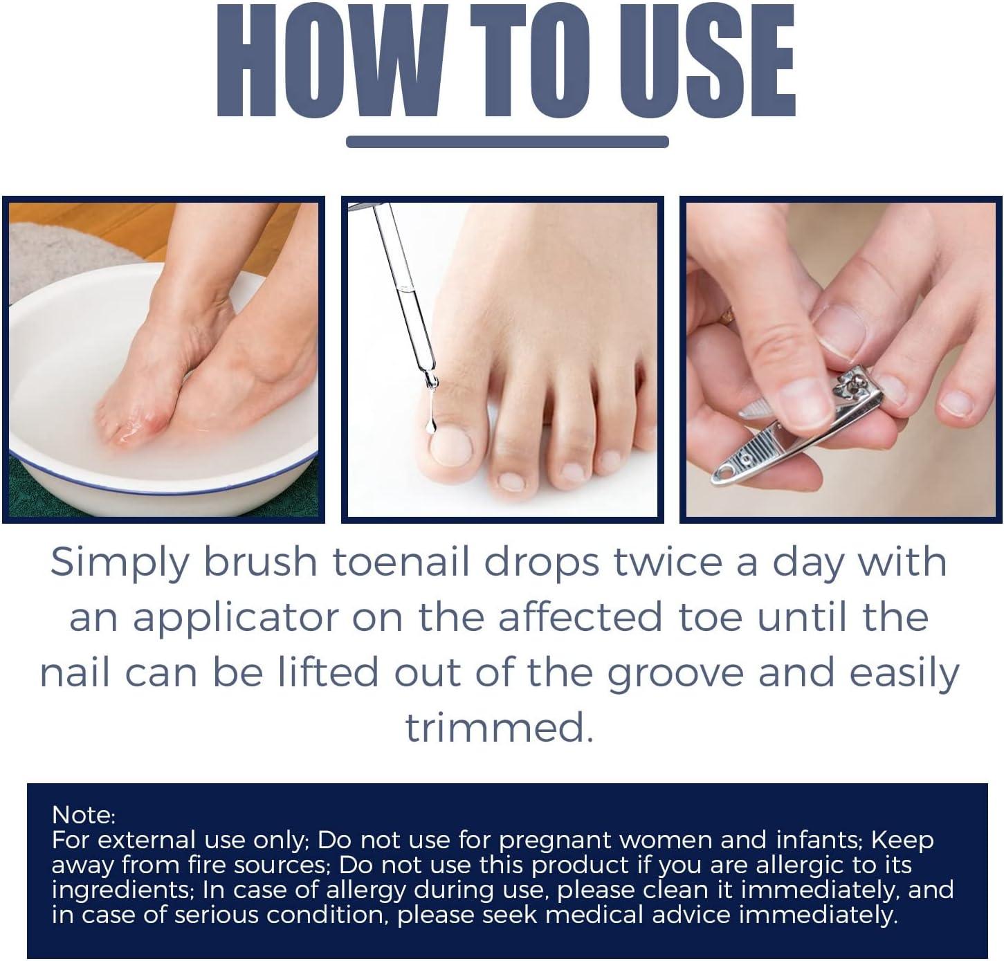 2PCS Ingrown Toenail Treatment Anti Paronychia Relief Oil Ingrowing