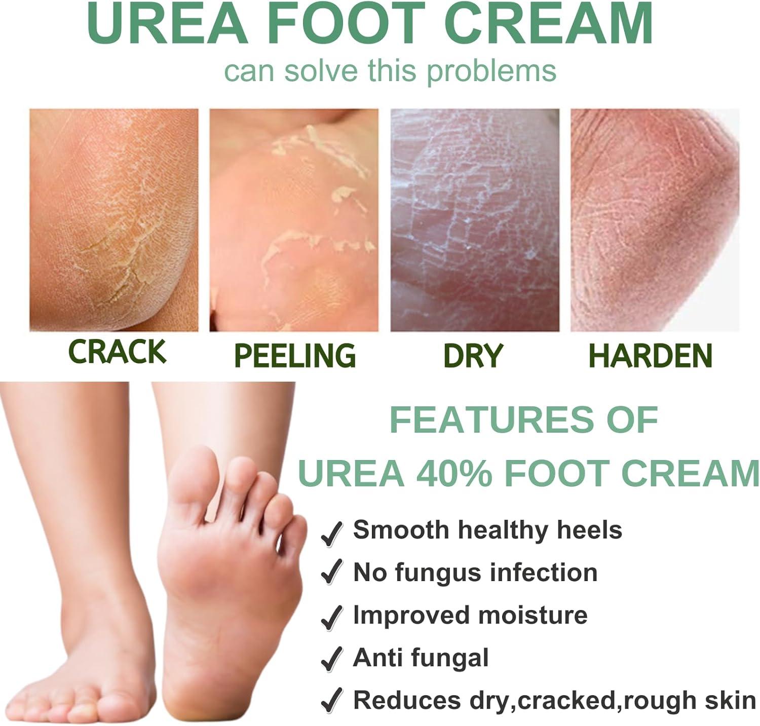 Urea 40% Foot Cream Urea Cream 40 Percent for Feet Hard Skin