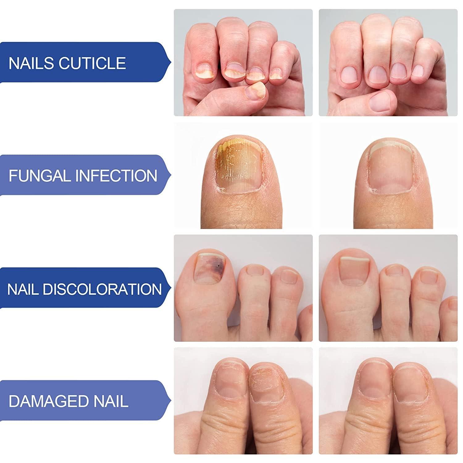 Fungal Infections - Randell's Footcare