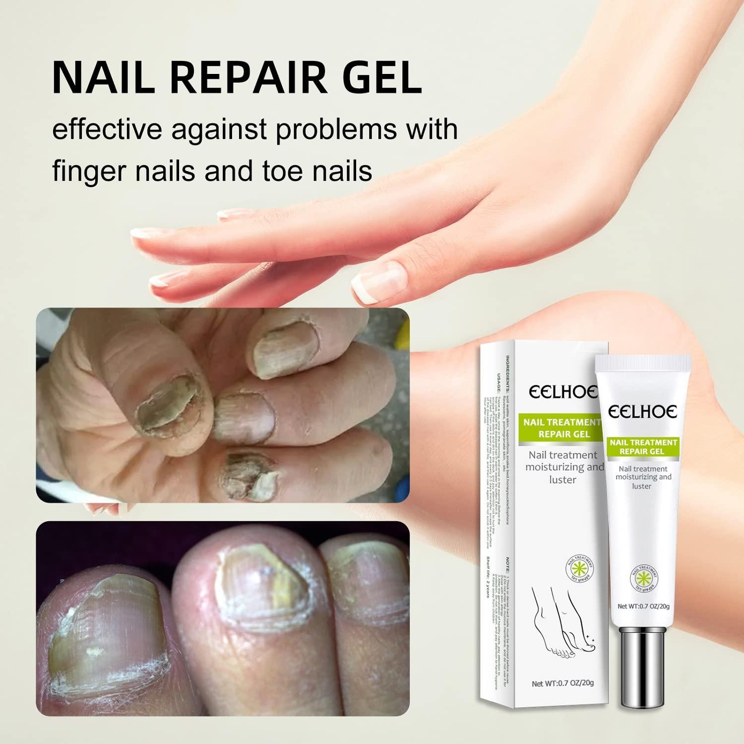 Efero 2PCs Nail Treatment Repair Gel Set Nail Repair Cream & Essence for Healthy, Beautiful