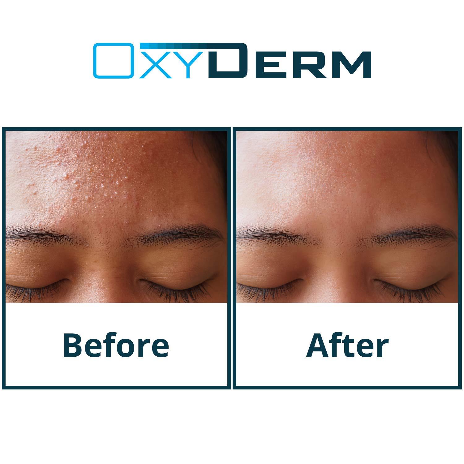 Acne Clearing Treatment Pads Exfoliating Peel Pads, Eliminates Acne