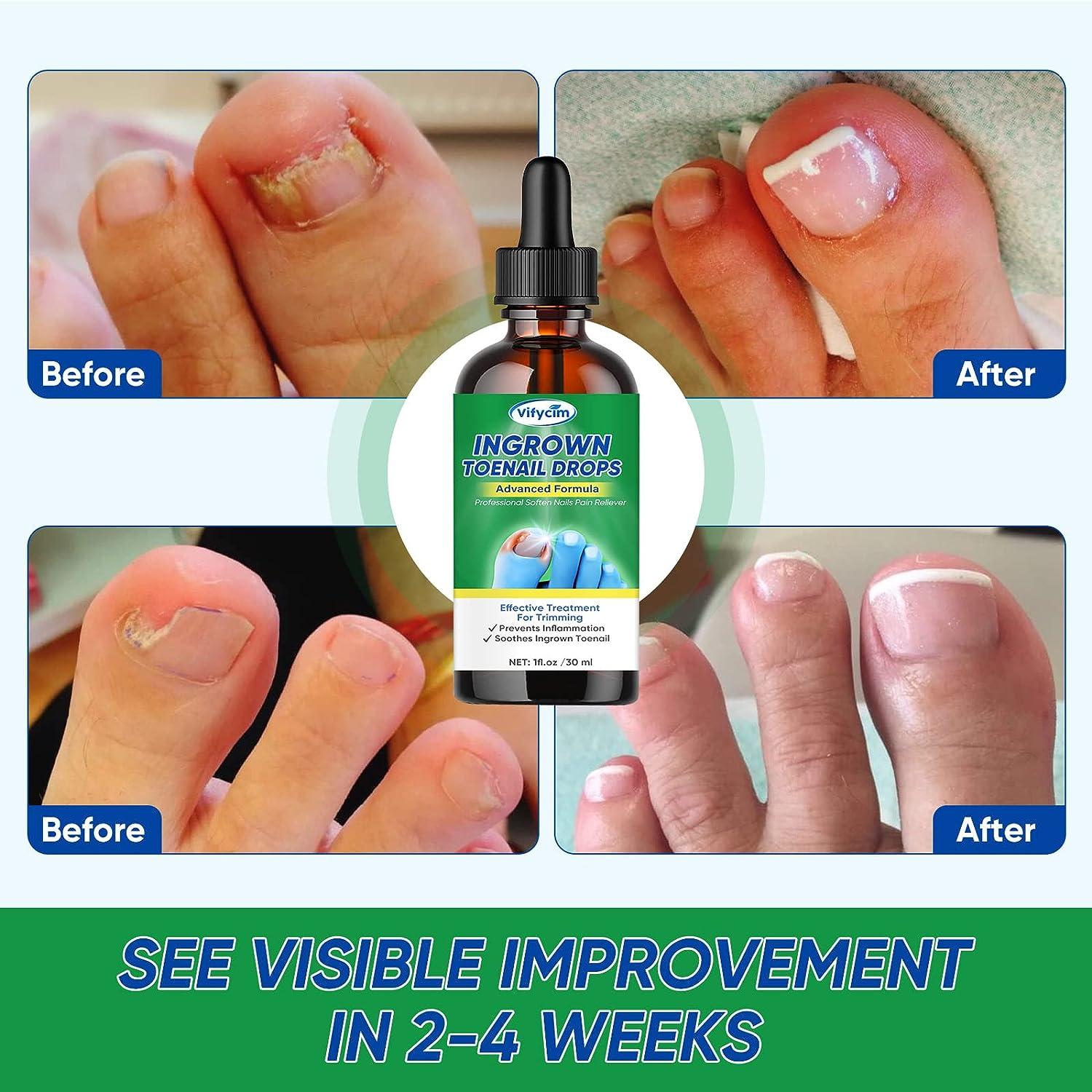 Ingrown Toenail Treatment Ingrown Toenail Corrector Drops Professional