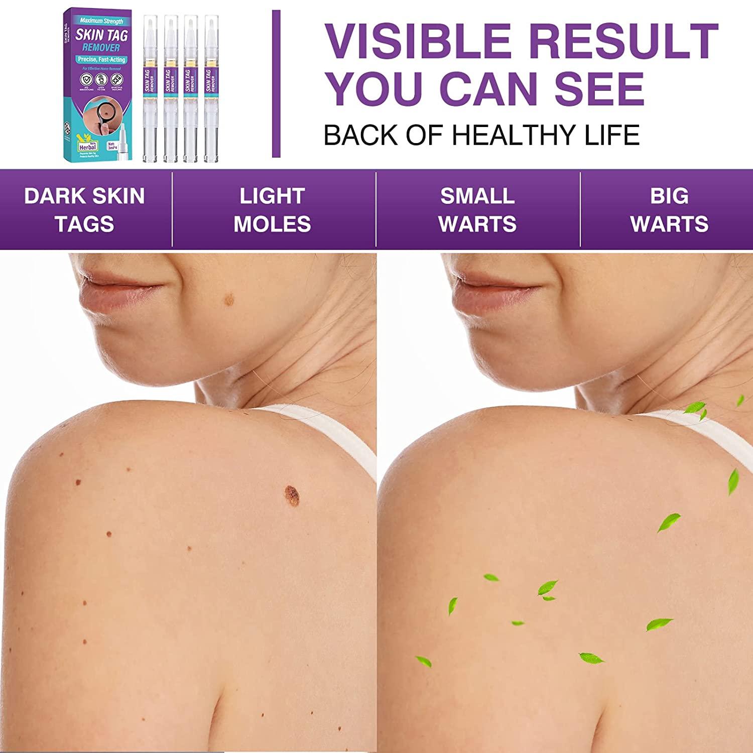 Skin Tag Remover, Extra Strength Wart Remover FastActing & Easy to Apply, Tag Dry and Fall