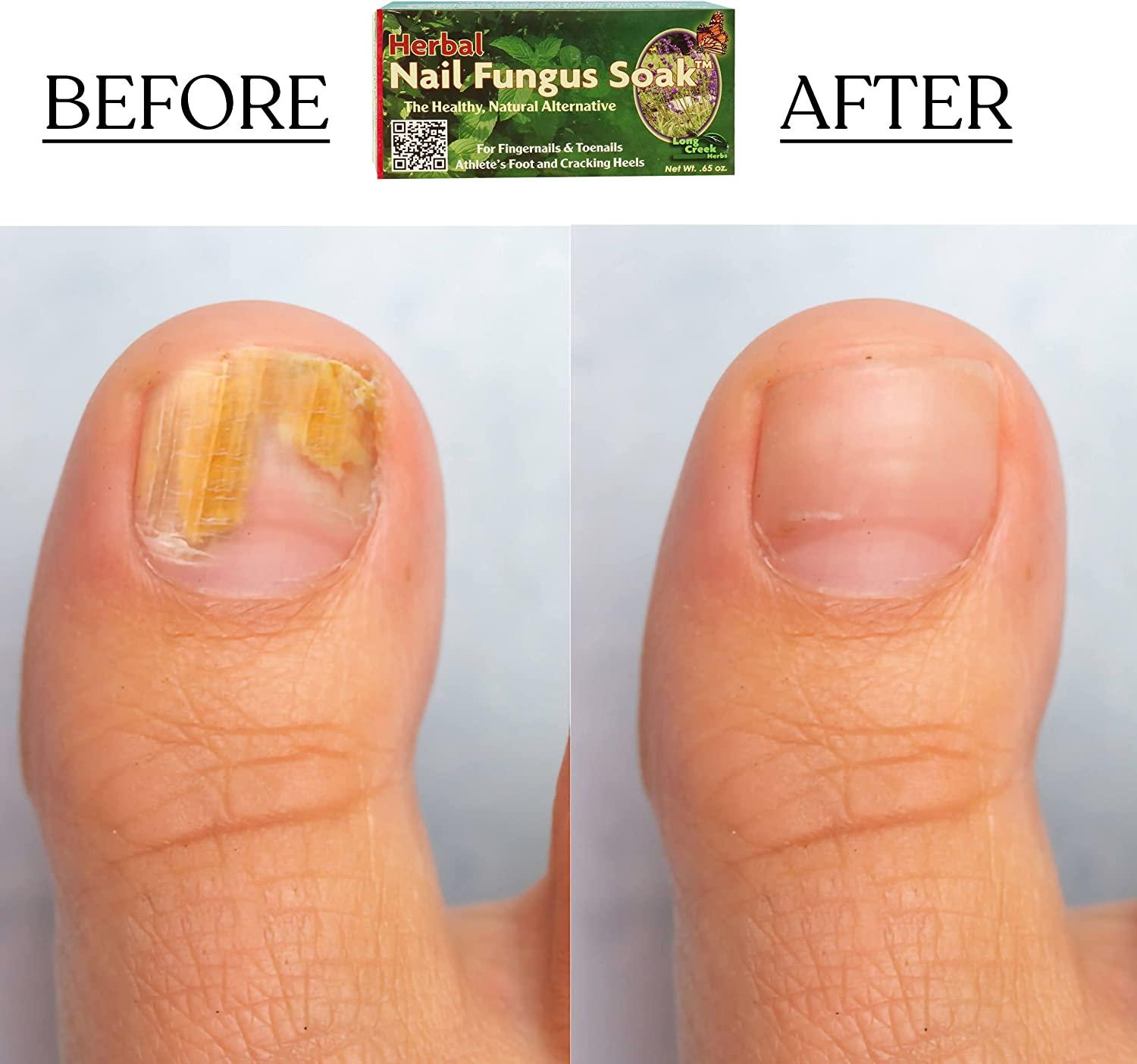 Nail Fungus Soak - Natural Topical Toenail and Fingernail Solution - Fight  Cracked Heels and Athlete's Foot - Hypoallergenic Daily Fungus Remover for  Feet and Hands