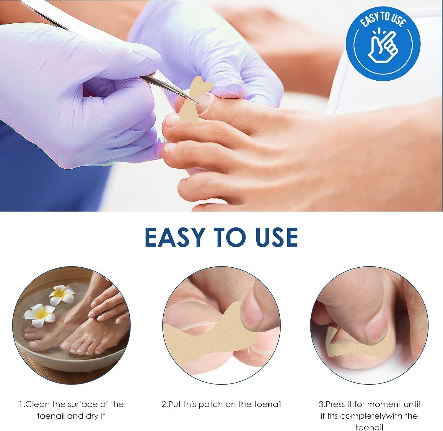 Ingrown Toenail Treatment 50Pcs No Glue Ingrown Toenail Corrector Patch