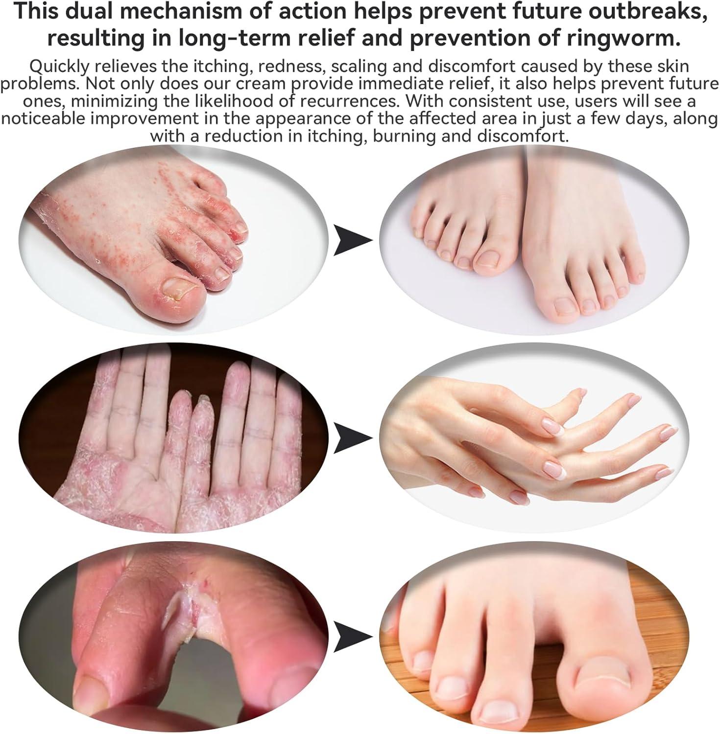 Psoriasis Dry Scaly Feet Itchy Feet Relief Cream Soothing