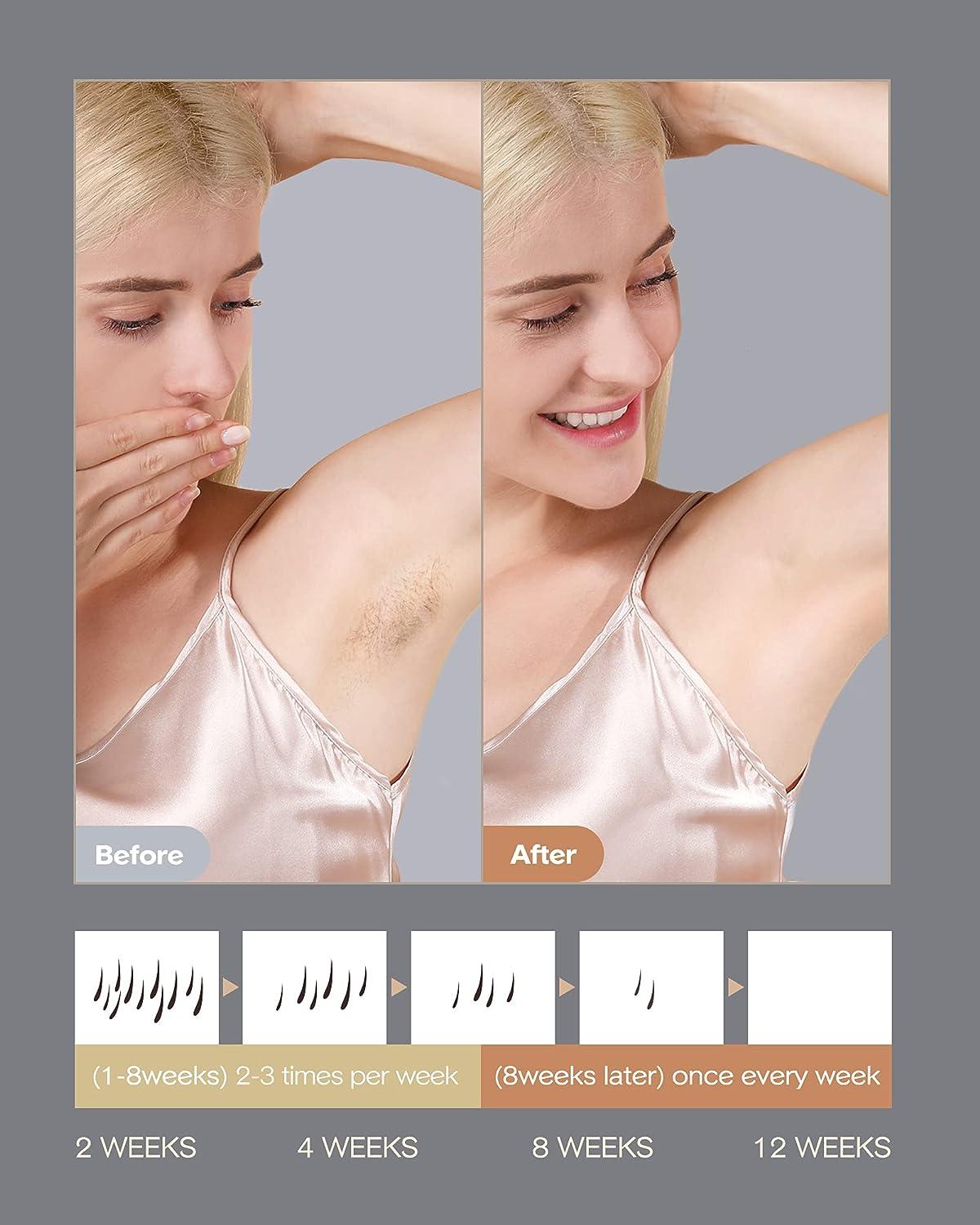 Gold Laser Depilacion Laser San Miguel Láser Shr Depilacion Santa