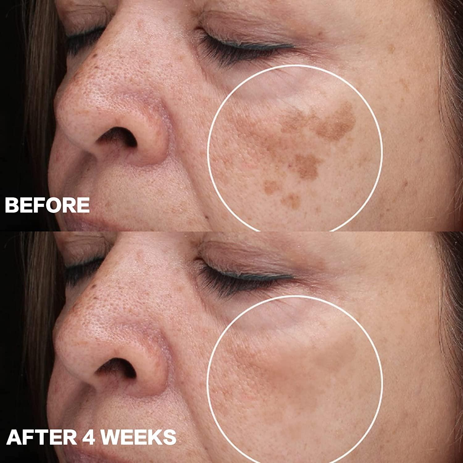Dark Spot Remover for Face and Body, Dark Spot Corrector for Face, Sun  Spots Melasma Cream and Freckle Remover- Formulated with Arbutin,  Niacinamide & Vitamin E