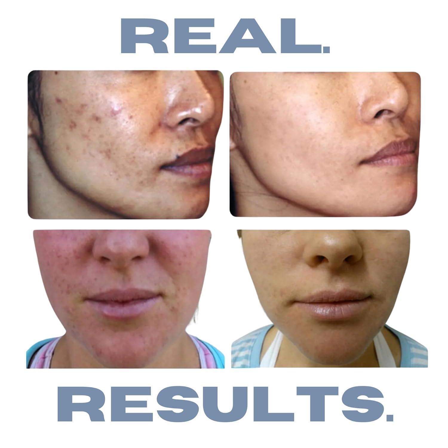 Natural Hormonal Acne Solution | Anti-DHT Ingredients