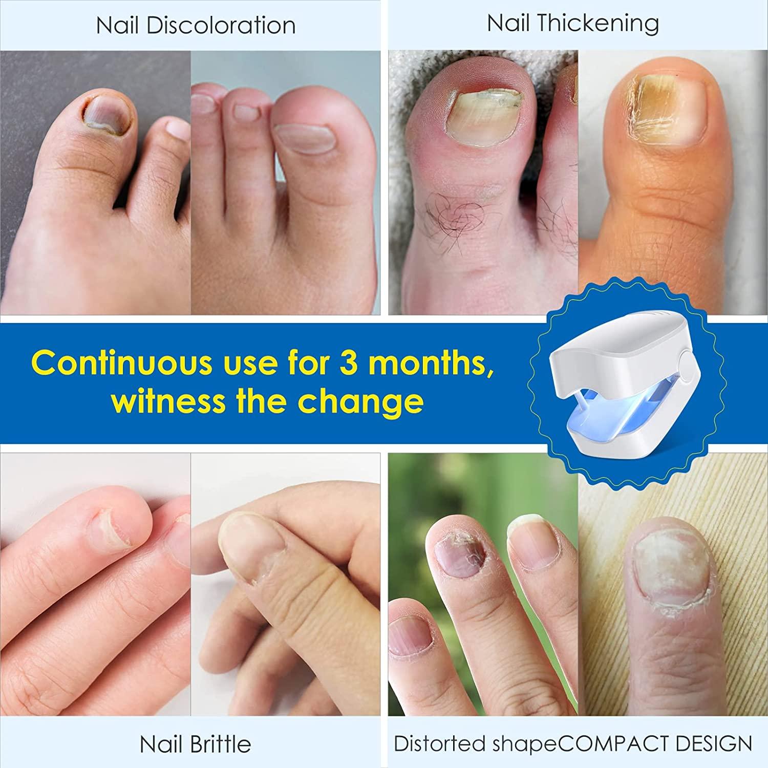 PODERM – 2 in 1 TOENAIL INTEGRAL RENEWAL – Restores Appearance of Discolored/Damaged  Nails – Toe and Fingernail