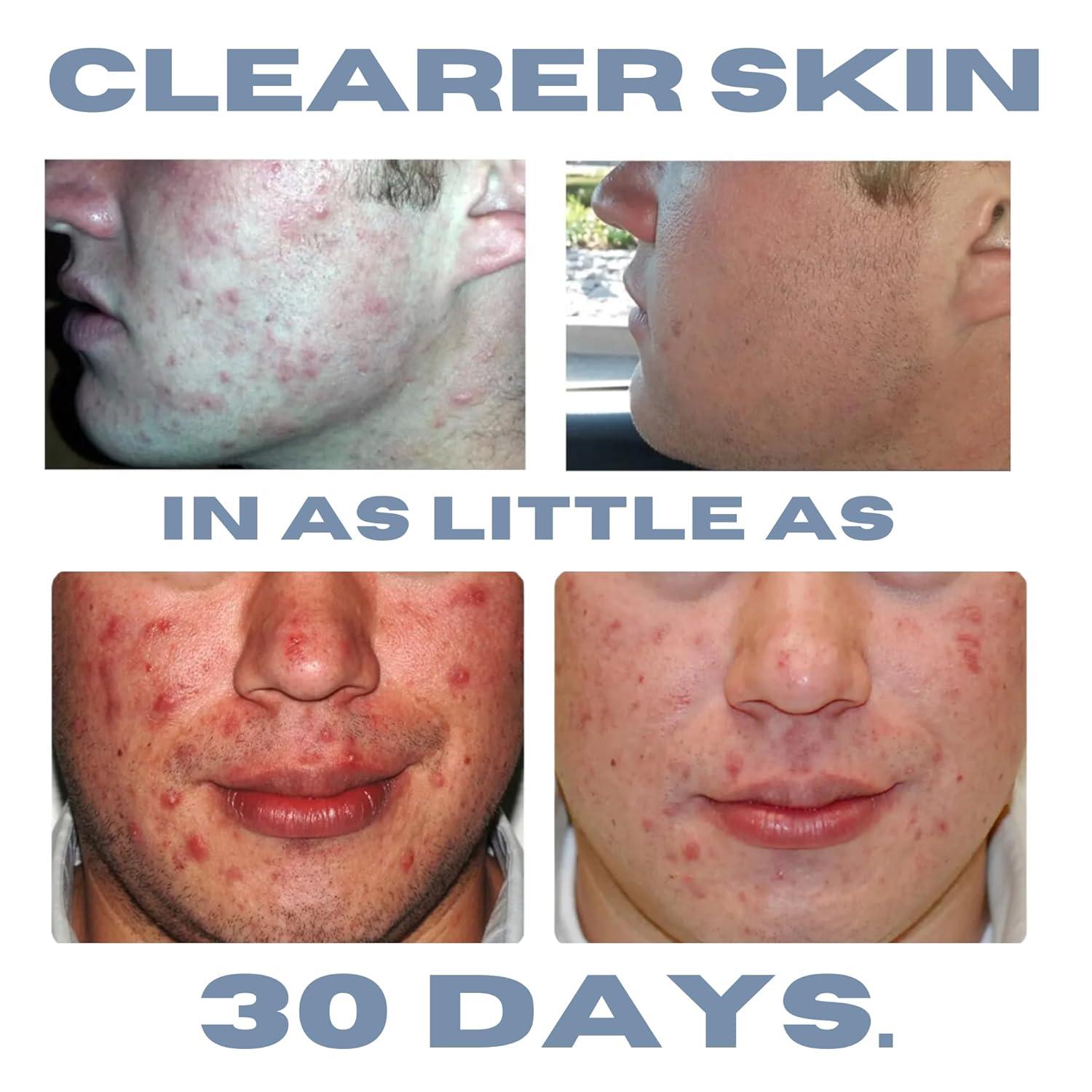 Natural Hormonal Acne Solution | Anti-DHT Ingredients