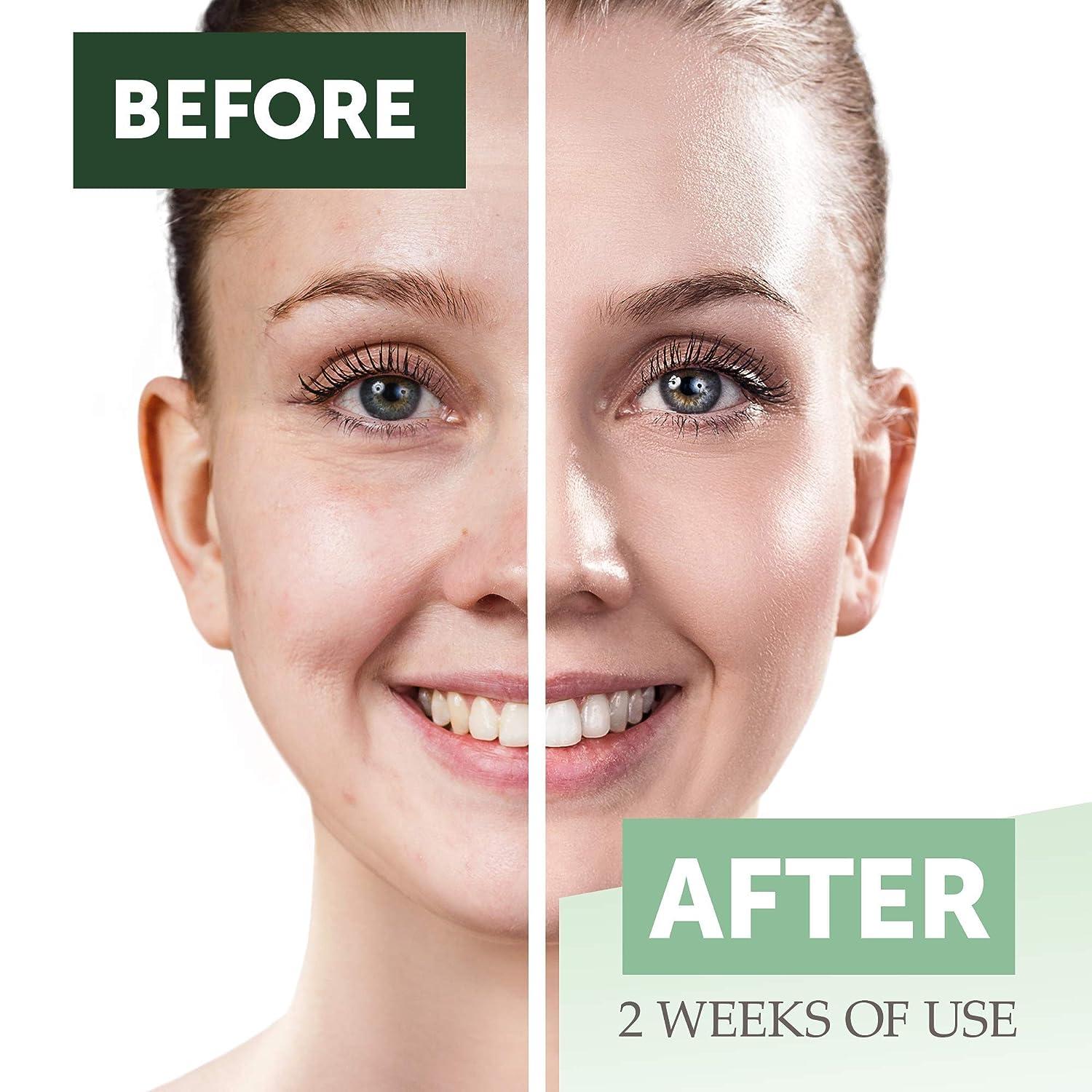 Measurable Difference Glycolic Acid Serum 5 for All Skin Types Alpha Hydroxy Acid Facial Peel