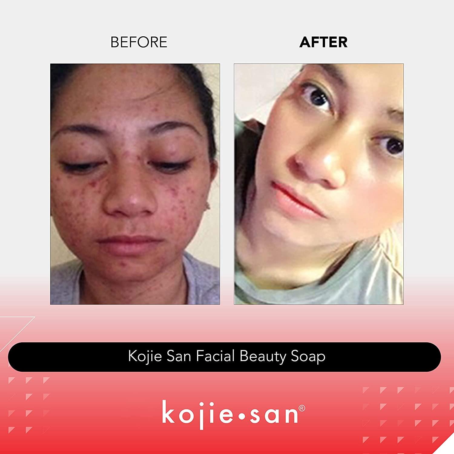 Kojic Soap Before And After