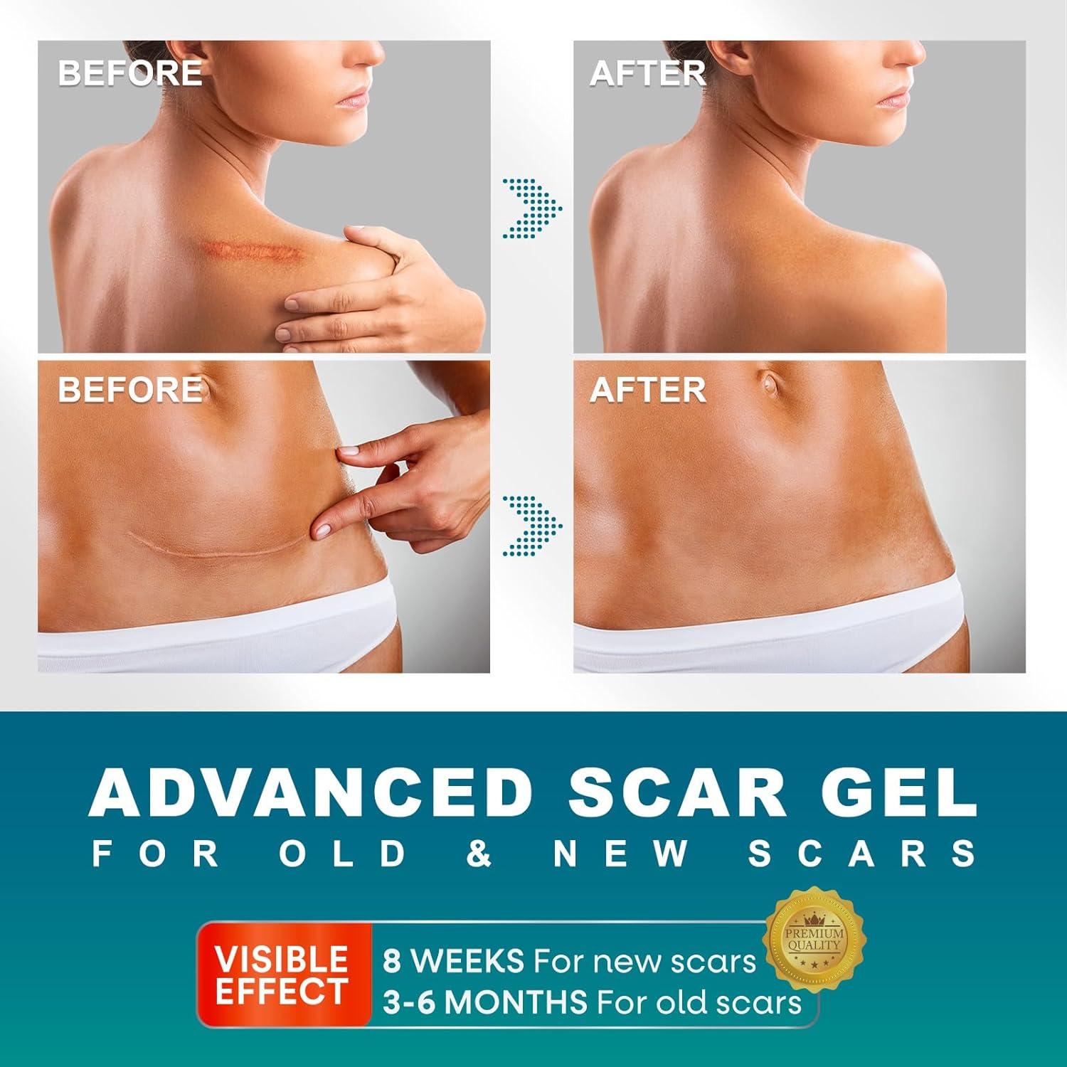 Advanced Scar Gel & Cream for Surgical Scars | C-Section Tummy Tuck ...