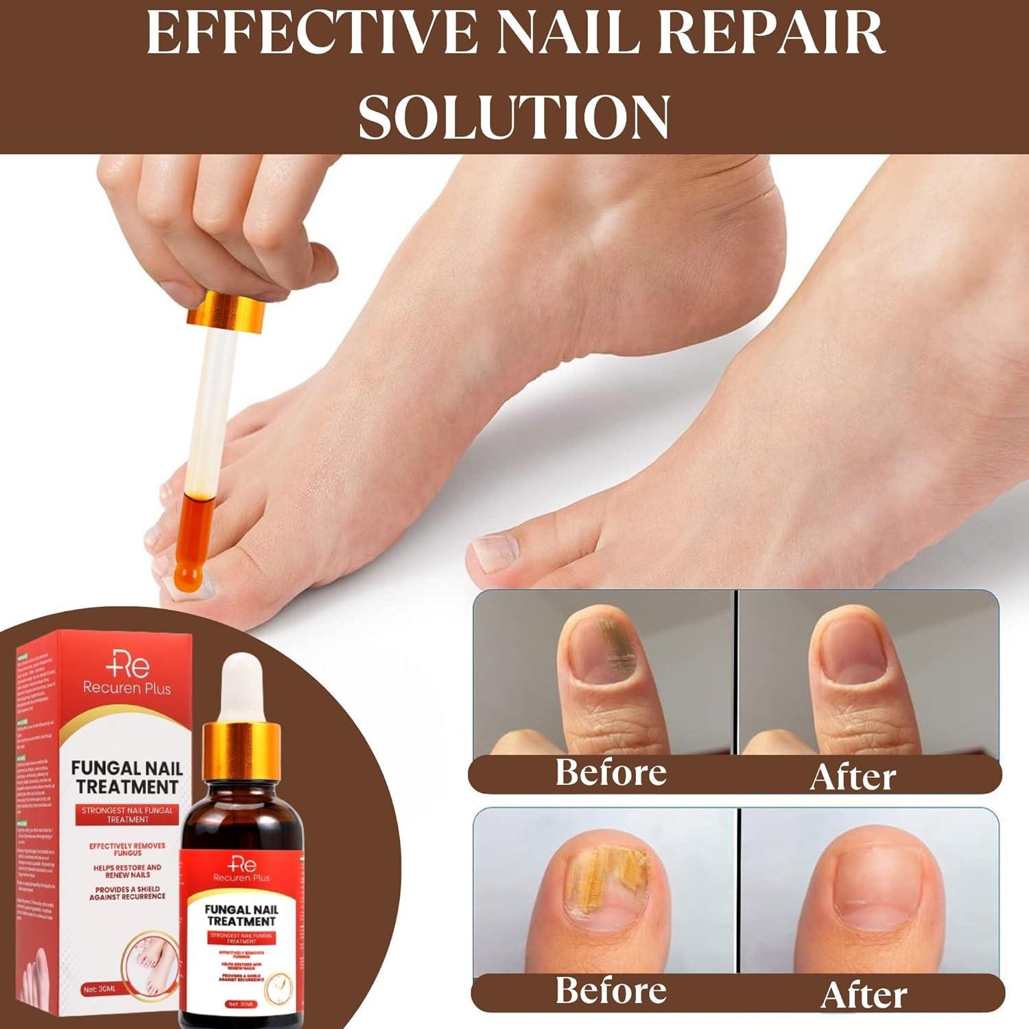 100ml Effective Anti-fungal Feet Infections Athlete Foot Nail Fungus Hand  And Foot Care Treatment Spray Beauty Health Care - Foot Care Tool -  AliExpress