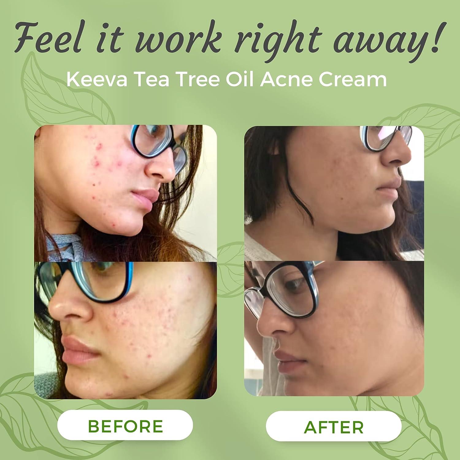 Keeva Organics Acne Treatment Cream With Secret TEA TREE OIL Formula -  Perfect For Acne Scar Removal Fighting Breakouts Spots Cystic Acne - See  Results in Days Without Dry Skin (1oz)