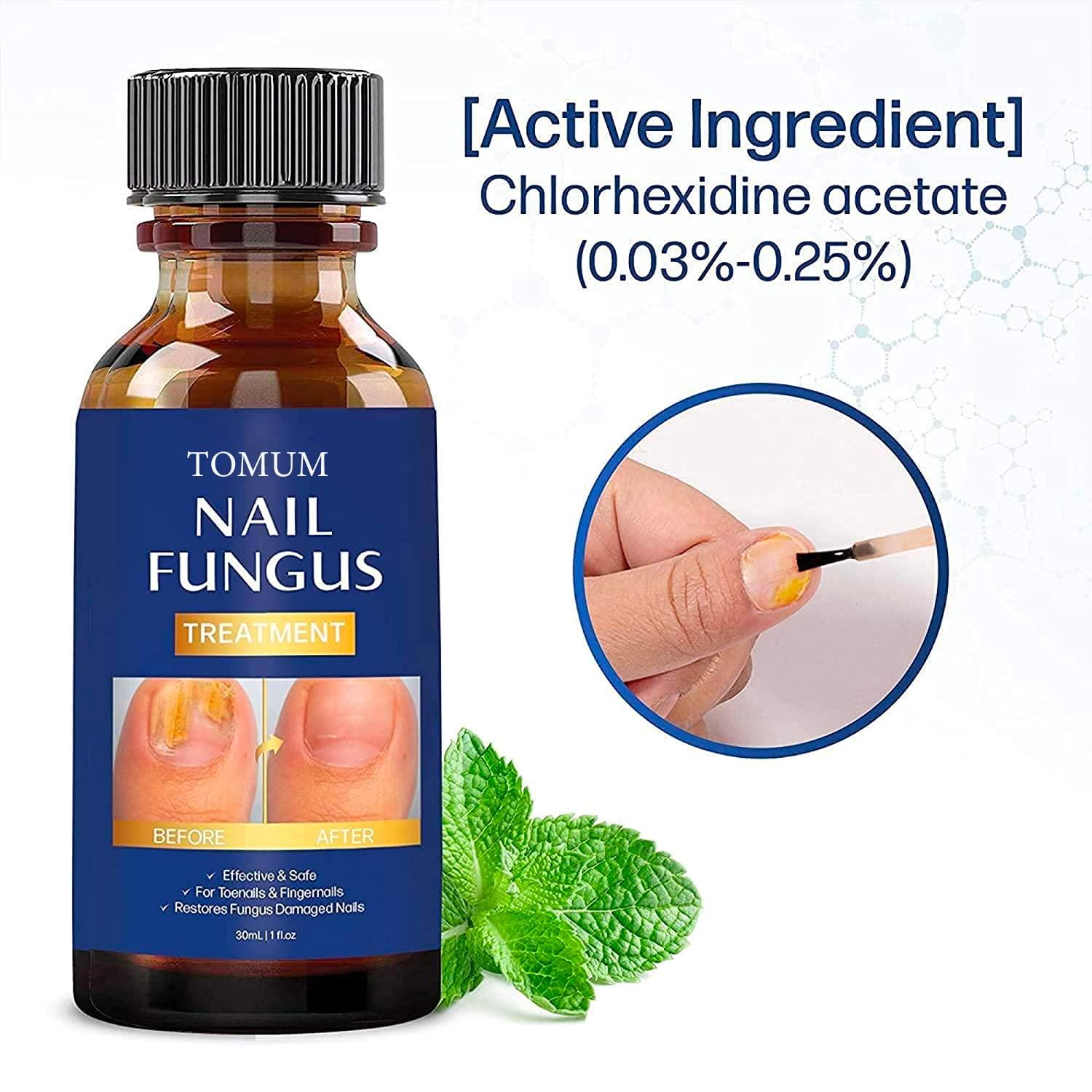 Toenail fungus treatment Nail Fungus Treatment for Toenail Toe Nail