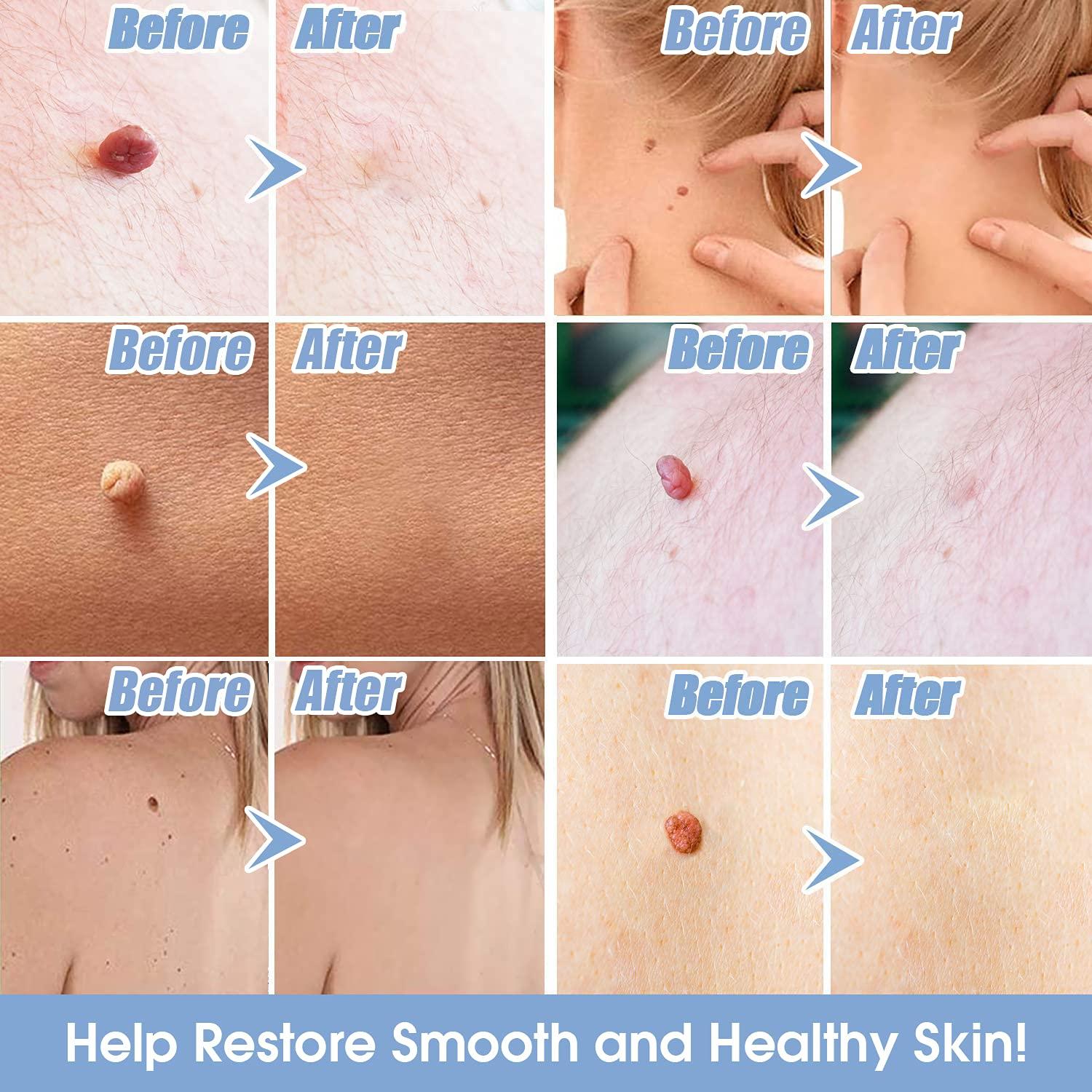 Skin Tag Remover Removes Skin Tags in as Little as 1 Treatment