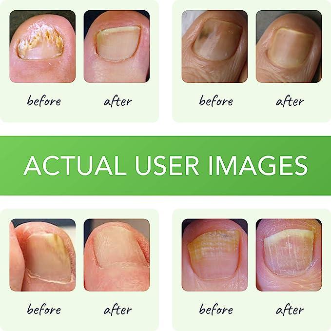 Funginix Healthy Nail Formula USAMade Treatment for Finger and Toe