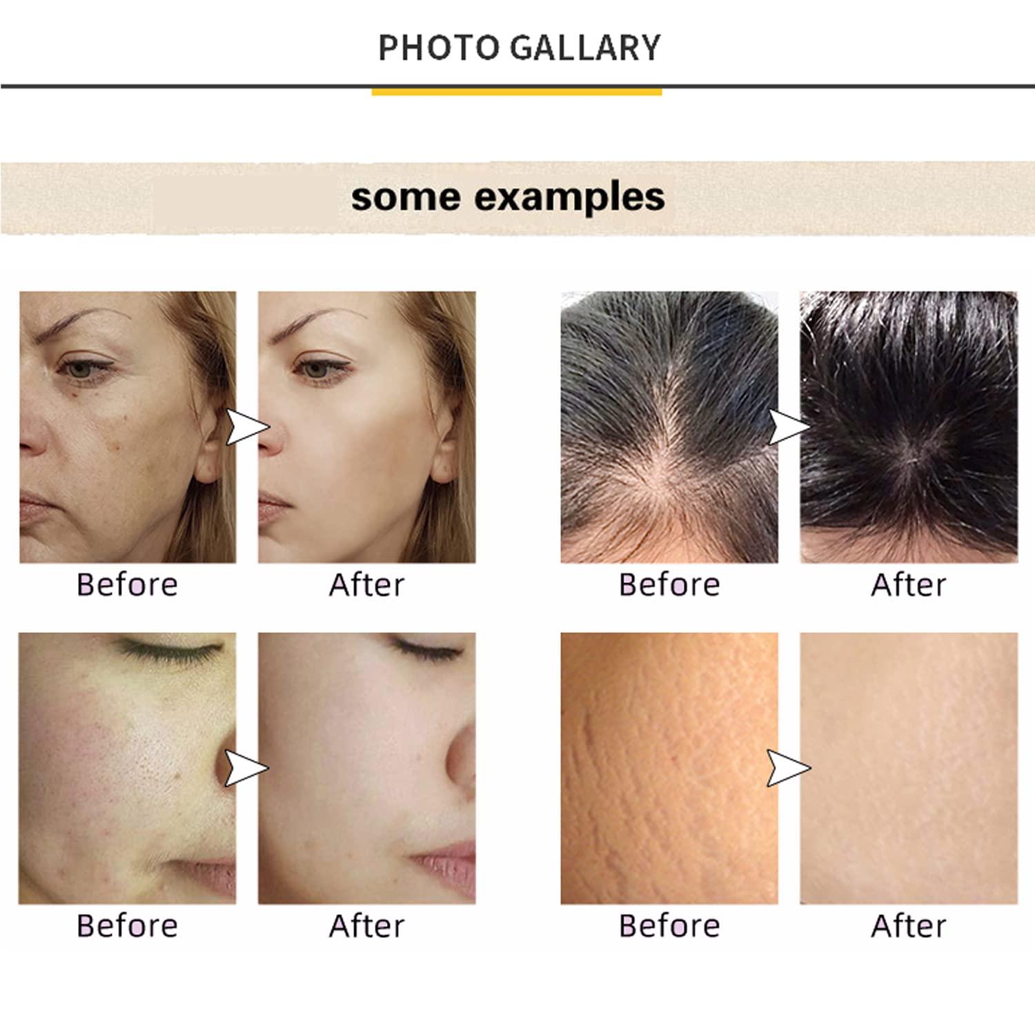 Koi Beauty Professional Derma Stamp Adjustable Titanium Microneedling