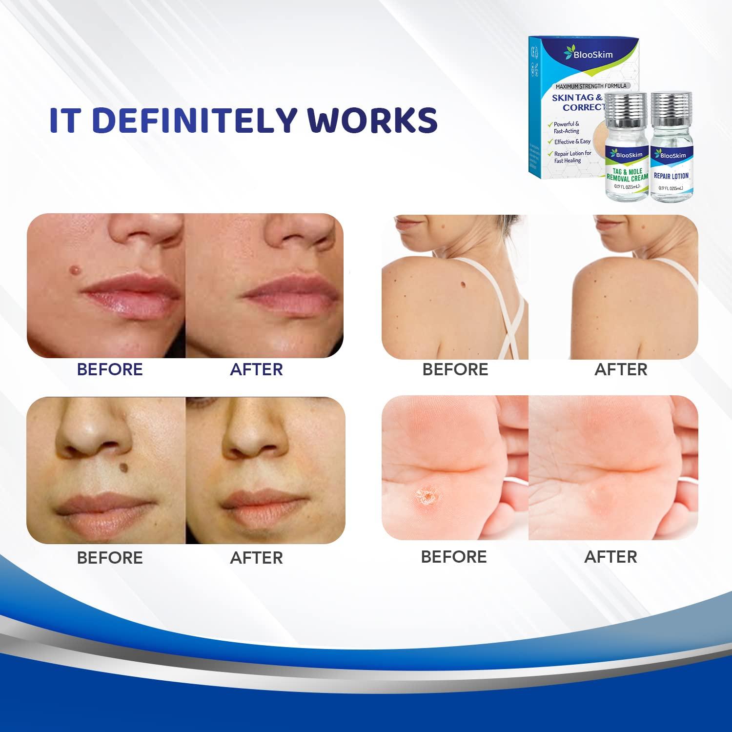Mole Removal and Repair Gel Set, Skin Tag Remover, Remove Effectively
