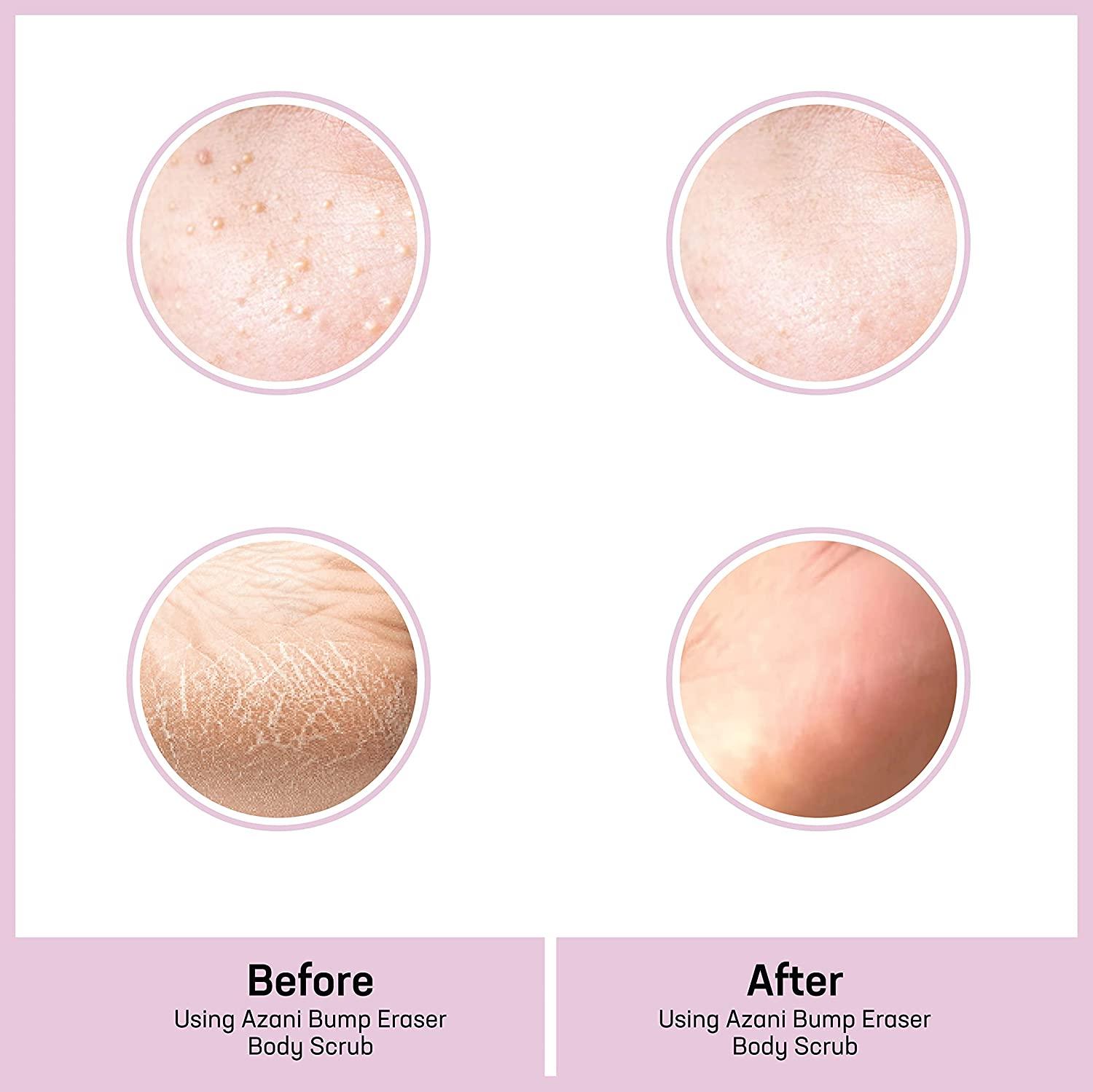 Azani Bump Eraser Body Scrub 5 Glycolic & Lactic Acid Exfoliator