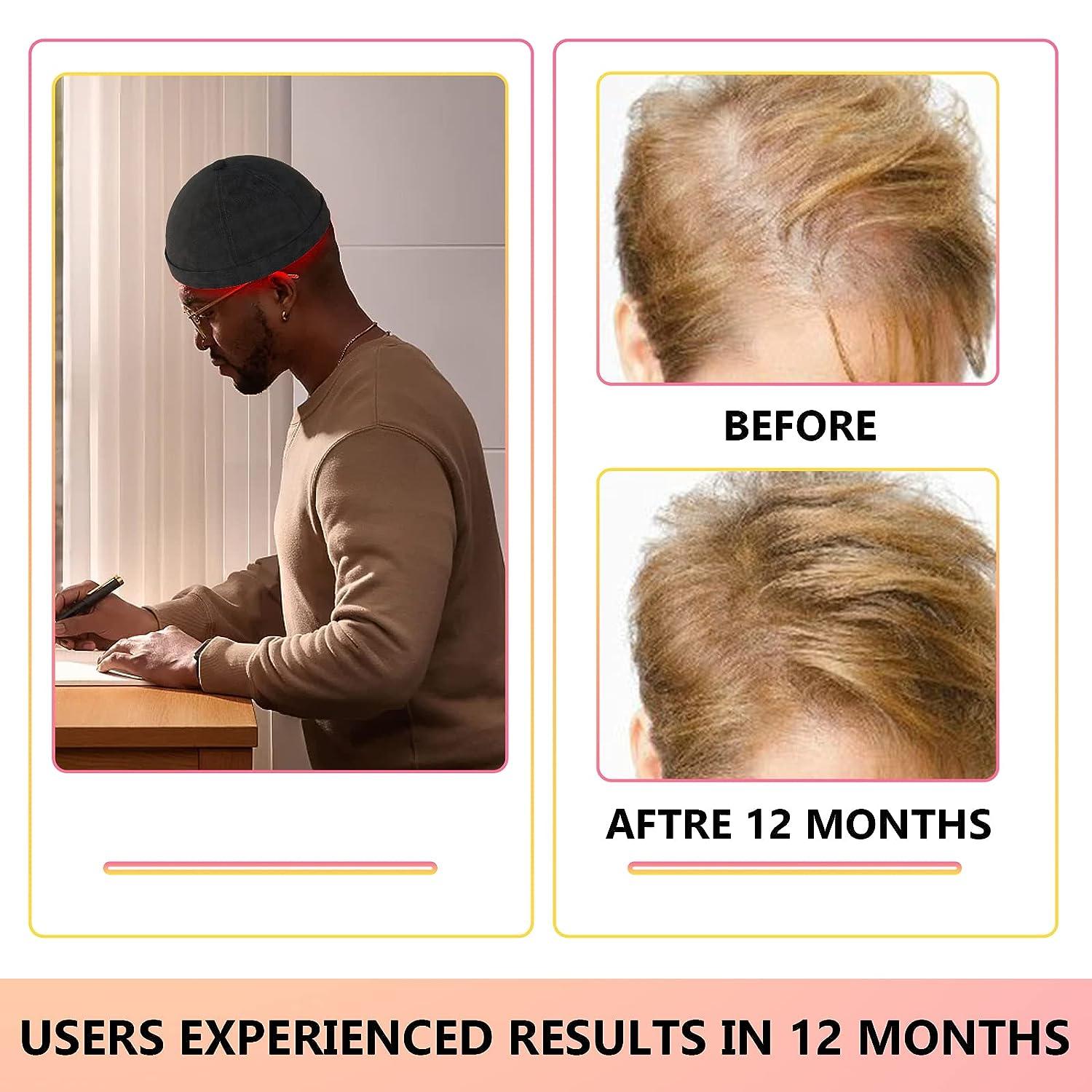 iKeener Laser Hair Regrowth Cap (FDA Cleared) Red & Blue Light Hair