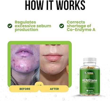l carnitina produce acne ACNEtane | Acne Pills for Cystic Acne | Hormonal Acne Treatment with  Vitamin Complex & L-Carnitine | All-Natural Non-GMO Supplements for Teens &  Adults | 180 Vegan Capsules