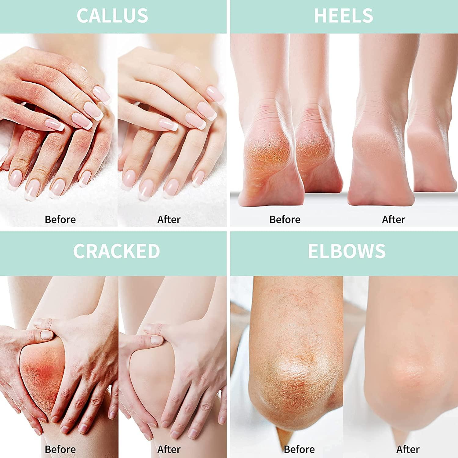 Urea cream for deals feet