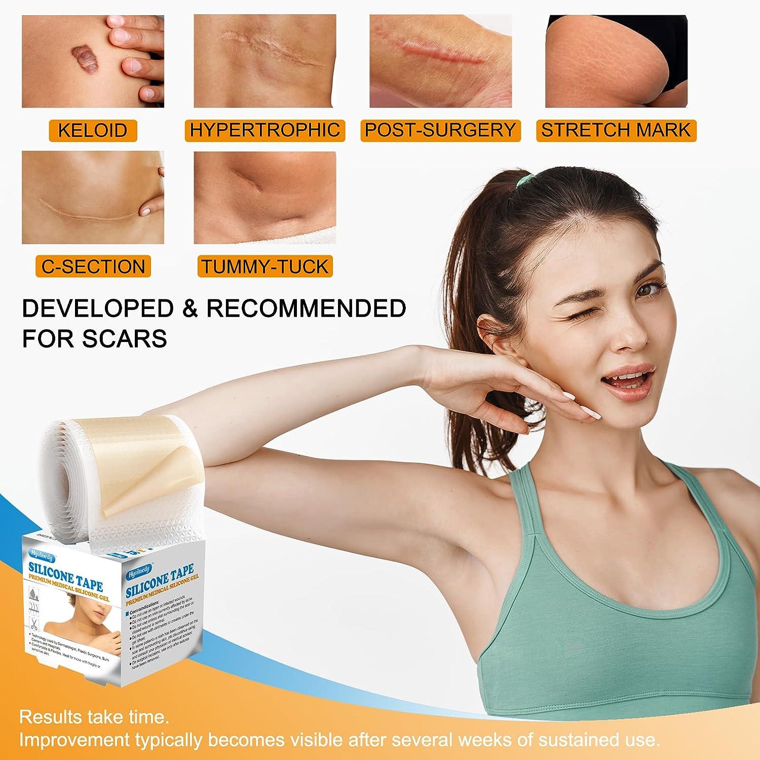Silicone Scar Sheets Silicone Gel Scar Tape Roll (1.6 x 591.5M