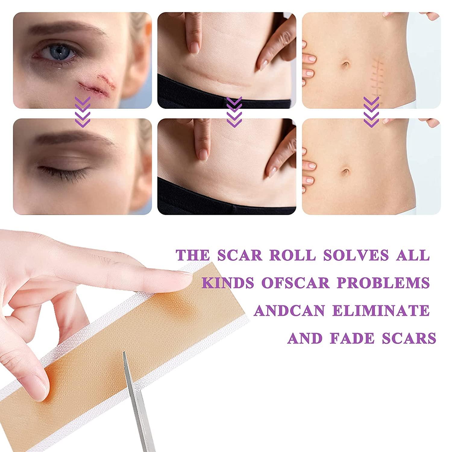 Silicone Scar Tape Roll, 1.6” x 60” Medical Tape for Wound Care