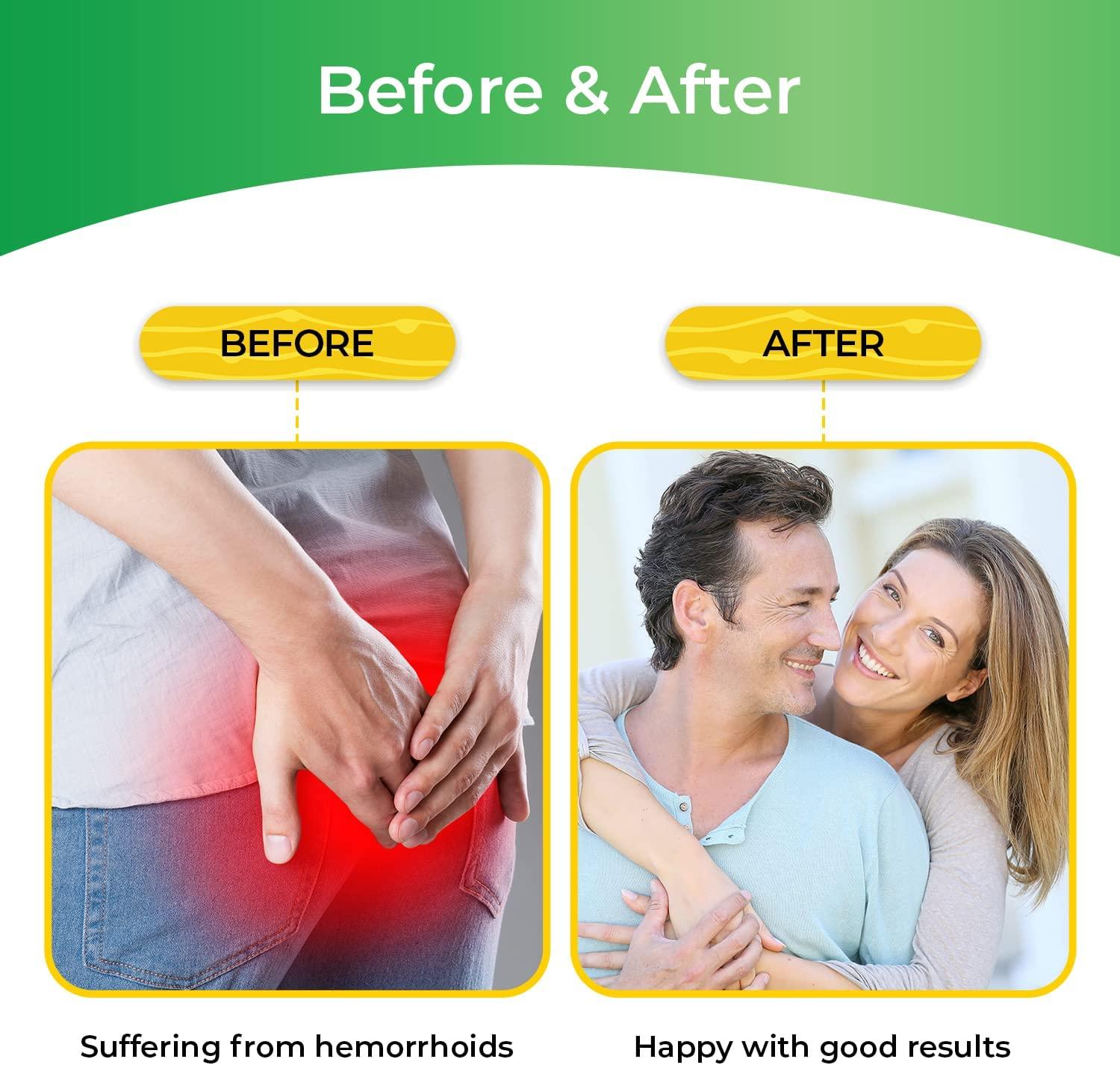 Hemorrhoid Treatment, Hemorrhoid Wipes, Witch Hazel Wipes for Hemroidal