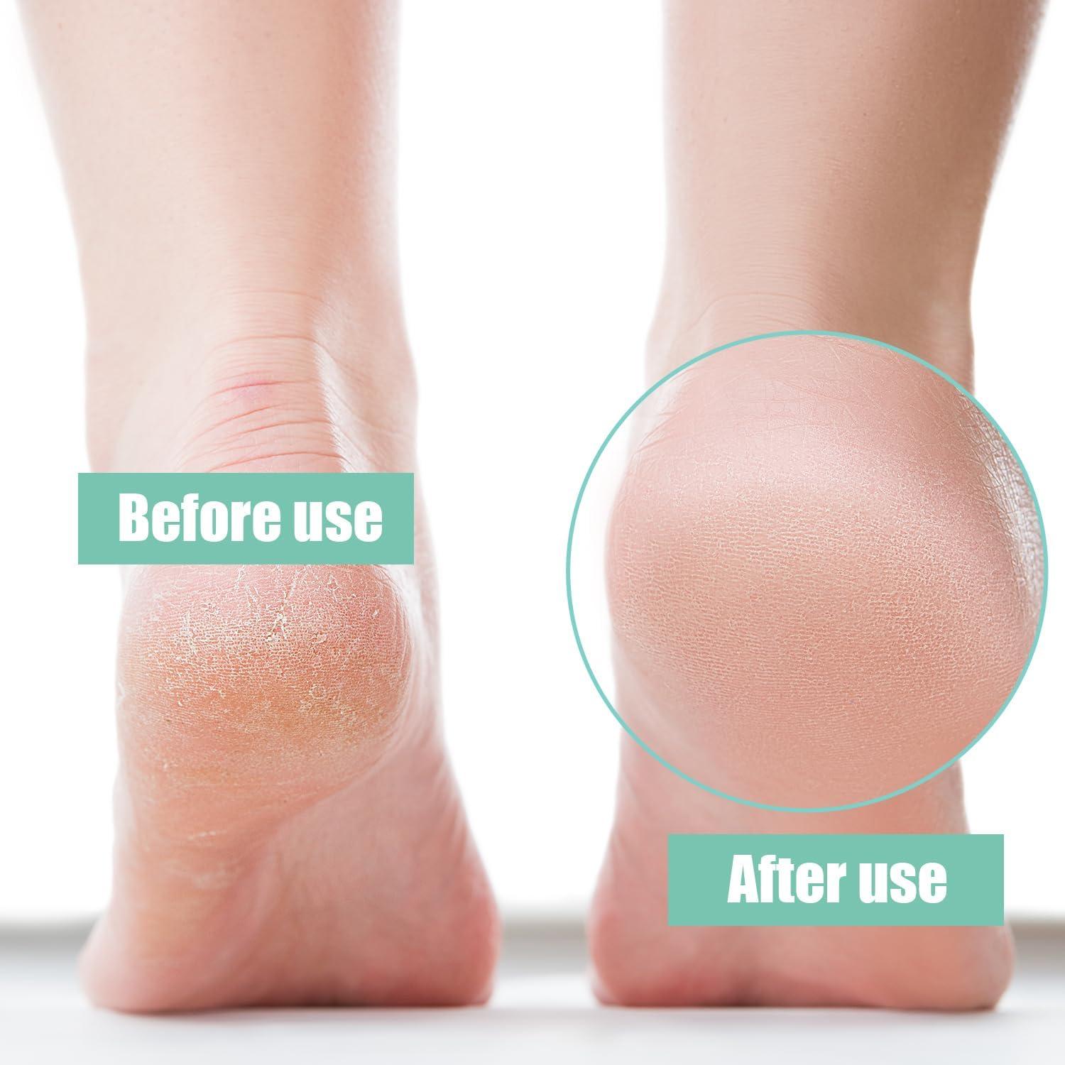 Pumice Stone for Feet Natural Lava Foot Scrubber Callus Remover Foot