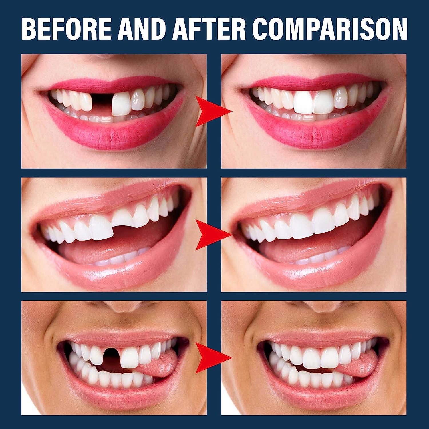Tooth Repair Kit,4Pcs Dental Tools,1Pcs 30ml Dental Repair Denture Repair  Beads,Temporary Tooth Repair Granules Tools Set for Temporary Fixing Filling  Missing Broken Tooth Moldable Fake Teeth(5Pack)