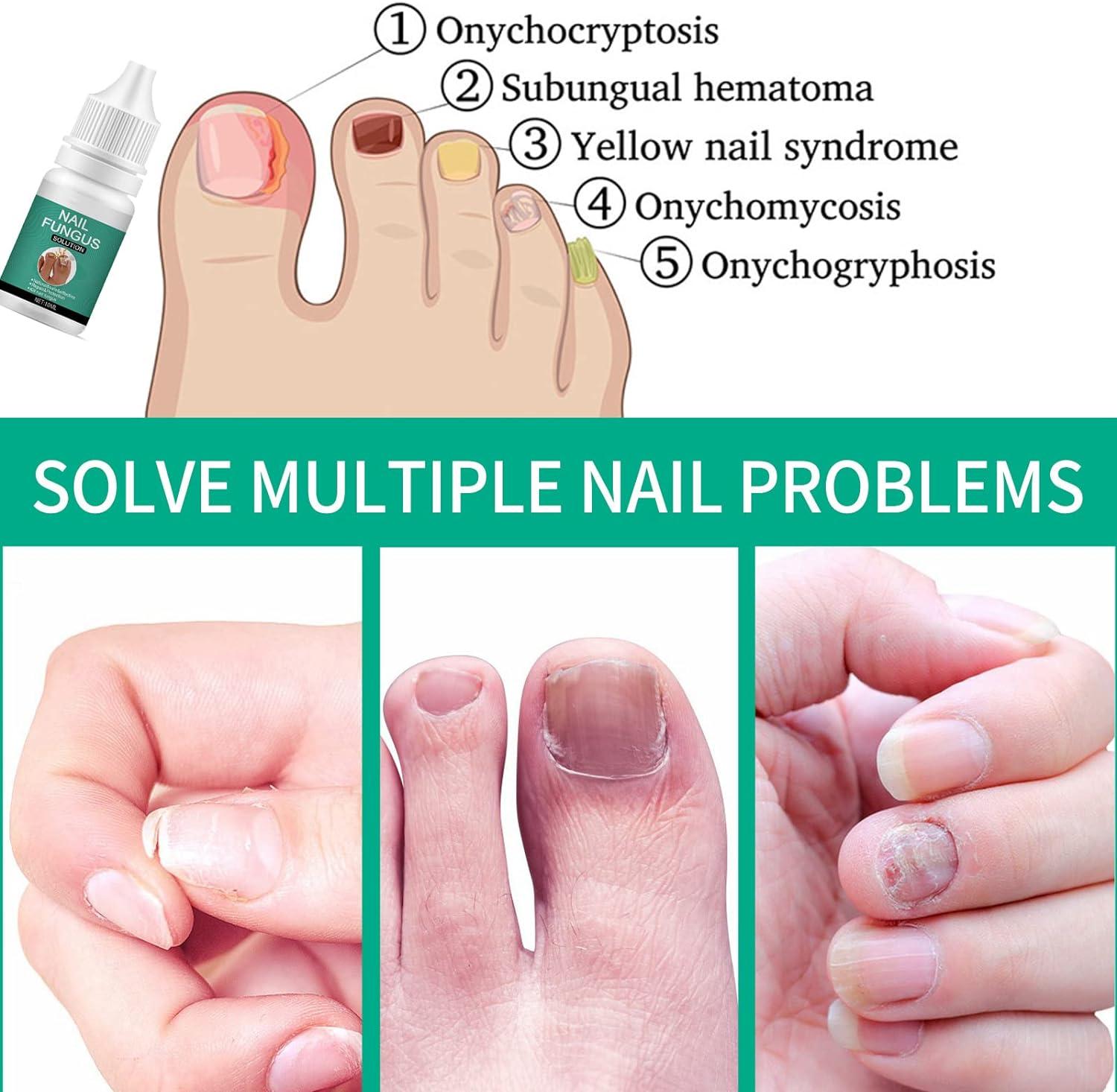 Fungal Nail Treatment for Toenail Extra Strong 10ML Nail Fungus Solution for Toenail Toenail
