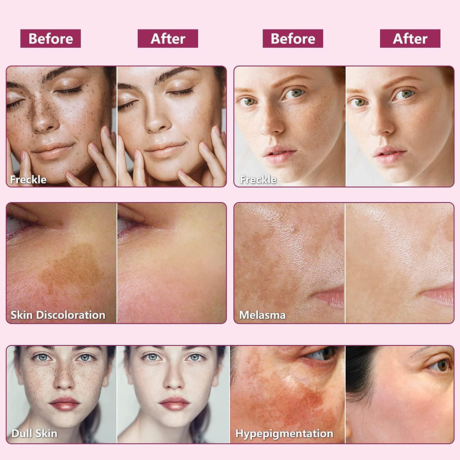 Dark Spot Remover for Face Dark Spot Corrector and Remover for use