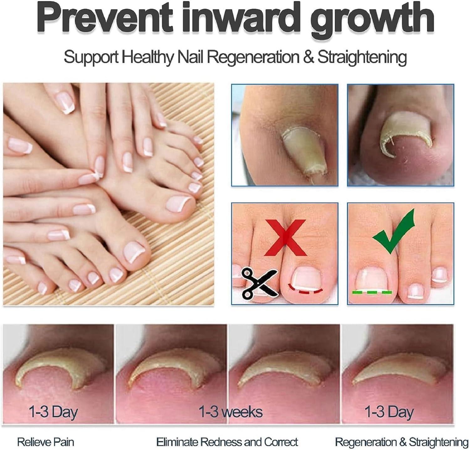 Ingrown Toenail Treatment Treatment for Ingrown Toenail Anti Paronychia