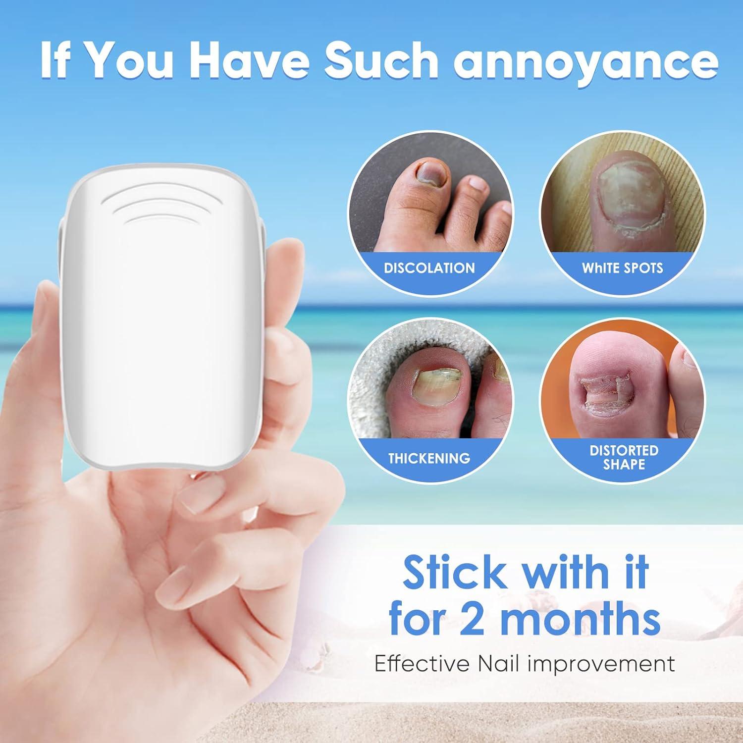 Nail Fungus Laser Treatment Device for Toenails Bzjslt Blue Light Nail Therapy for Damaged