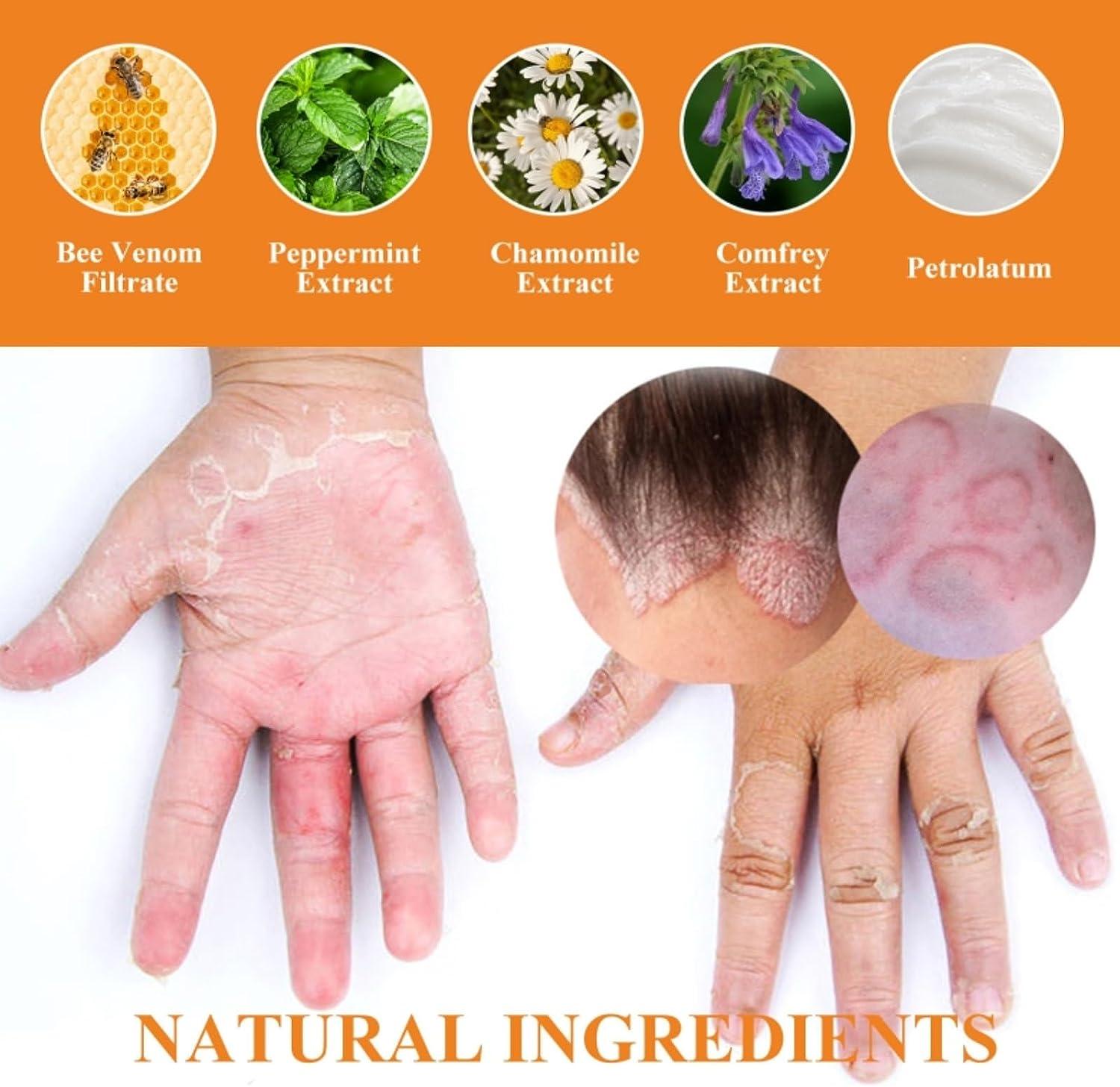 Suchergebnis Auf Für: Bienengift Psoriasis Creme