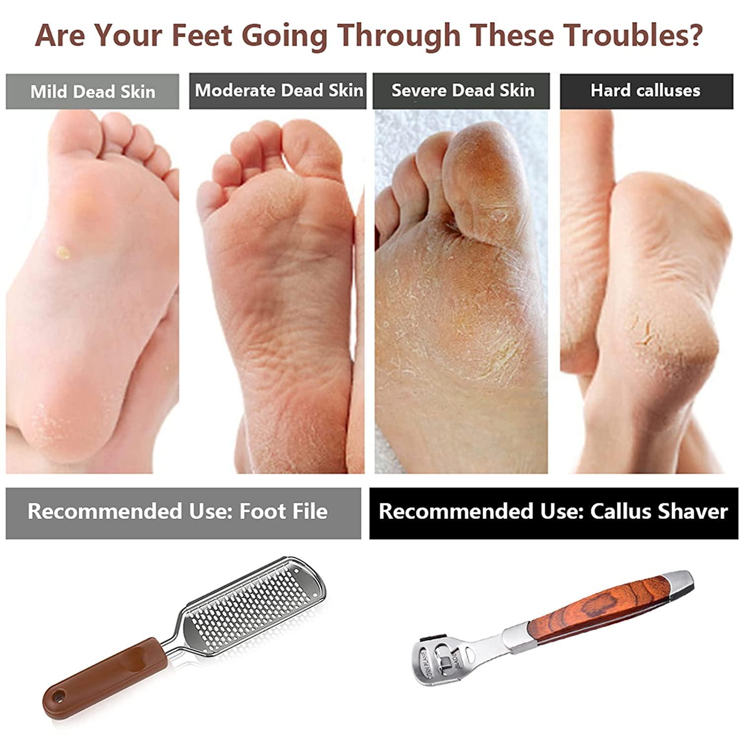 Colossal Foot Rasp & Wood Handle Callus Shaver (10 Replacement & 1 Foot File  Heads), Pedicure Foot File Kit, Heel Scraper For Feet, Foot File Callus  Remover